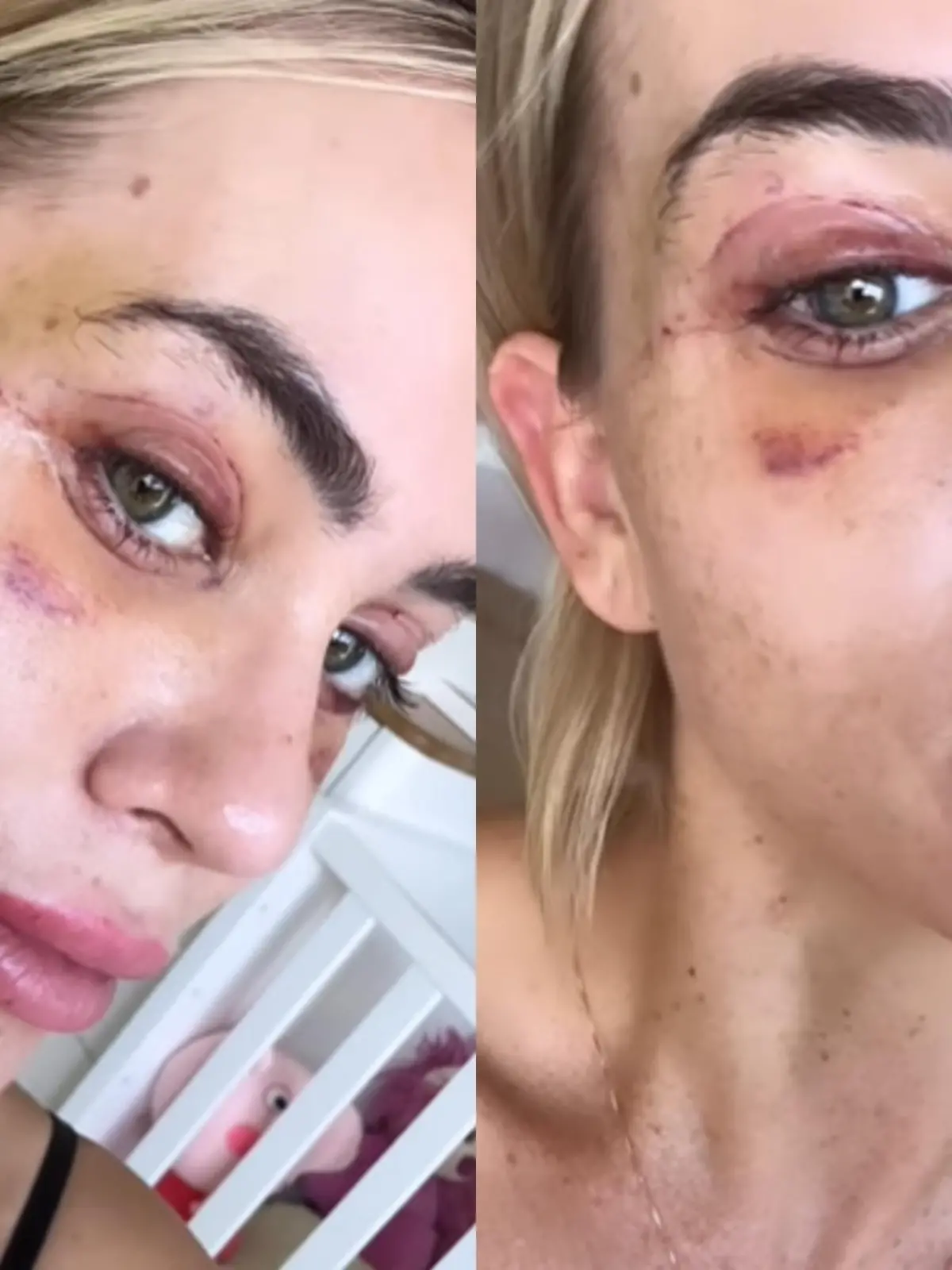 Jessica Haller nach Augenlid-Starffung