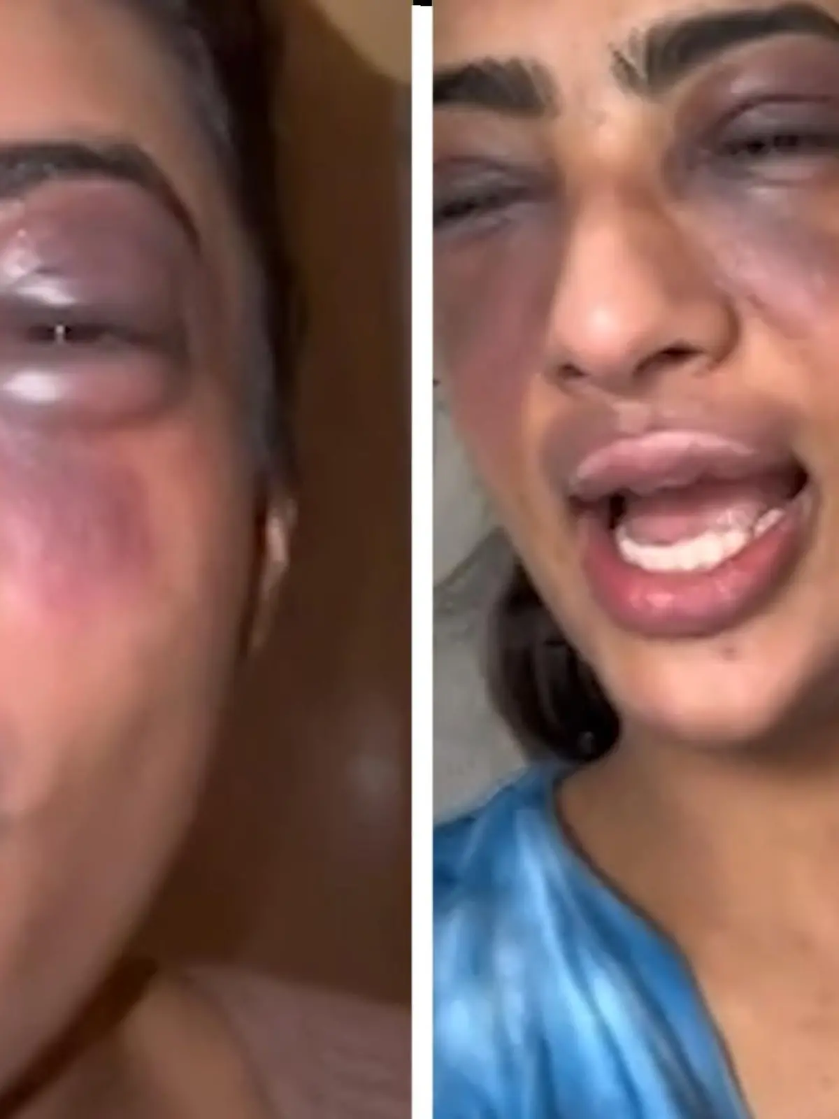 Die junge Frau hat eine allergische Reaktion, ihre Augen sind so zugeschwollen, dass sie kaum noch etwas sieht. Trotzdem geht sie nur aus einem Bauchgefühl heraus ins Krankenhaus – in letzter Sekunde!