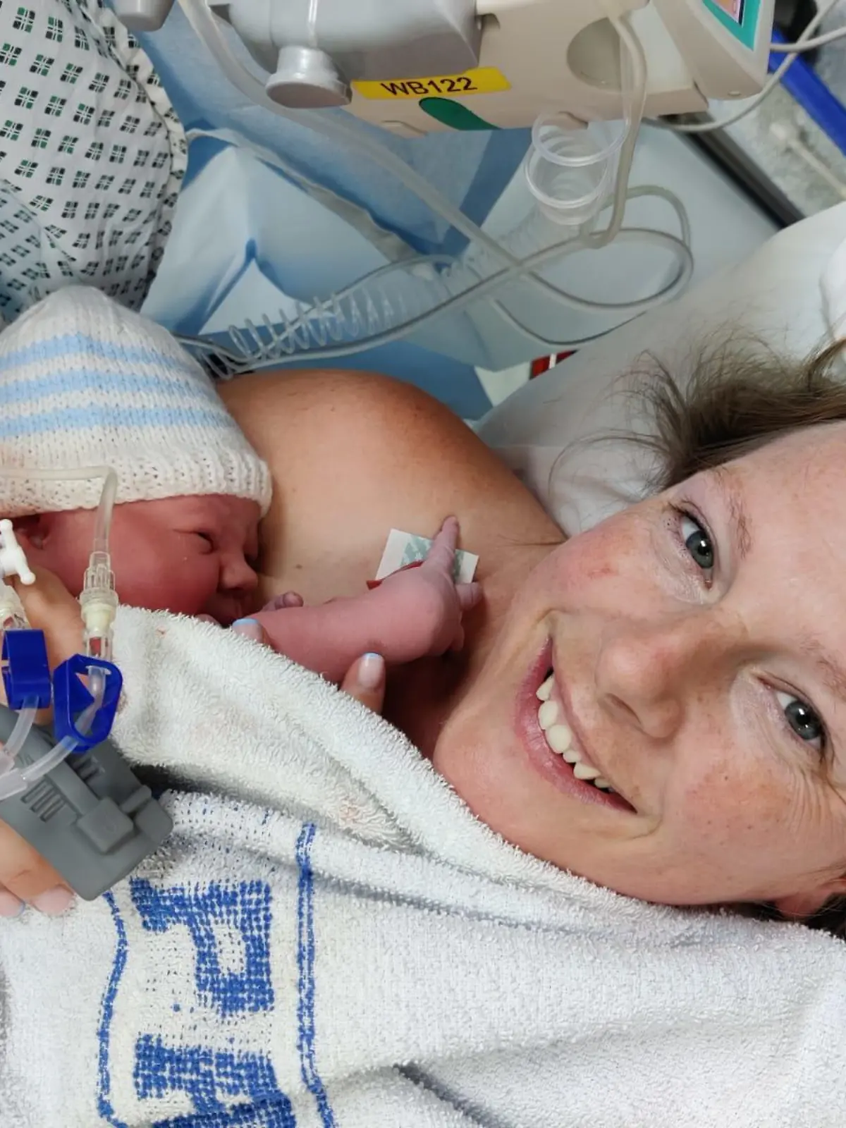 Story from Jam Press (Baby Without Bum) 

Pictured: Vickie after giving birth to her son, Charlie.

Doctors discover rare defect after a baby is born without BUM

A mum has shared the harrowing story of her baby being born without a bum – with the toddler undergoing six life-saving surgeries before his first birthday.

When Vickie Thompson and her fiancé, Alex, 37, gave birth to her son, Charlie, she was over the moon and at first had no idea that anything was amiss.

But just a few hours later, while still in hospital and unable to wake her child, who was in a cot next to her, the mum began to panic.

That’s when medical professionals reportedly discovered the child did not have a bum hole opening and immediately rushed the child to have his stomach pumped.

“I was absolutely petrified... I thought he was dying,” the 36-year-old beauty therapist from West Sussex, told Jam Press.

“The doctors said, ‘We don’t think he has an opening’.

“I was so scared.”

Having fed the newborn just a few hours prior to the shocking discovery, Vickie had also noticed her son had not yet pooped and his pee was a strange green colour.

Upon further investigation, doctors confirmed he had an imperforate anus, the narrowing or absence of the bum, a condition which affects one in 5,000 babies.

Whisking Charlie to the Neonatal Intensive Care Unit (NICU), the doctors removed the contents of his stomach to ensure no toxins remained.

The next day, he was transferred from Worthington Hospital to Brighton Hospital to have a stoma created, placing him under more specialist care.

A stoma is an opening in the abdomen connected to your digestive system, diverting waste away from the bowels and out of the body.

Charlie spent three days in the NICU after the major operation, two of which were in a coma.

The mum said: “I was petrified I was going to lose him.

“They had to put him on life support and I kept thinking he was going to die.

“I kept thinking the worst.”
