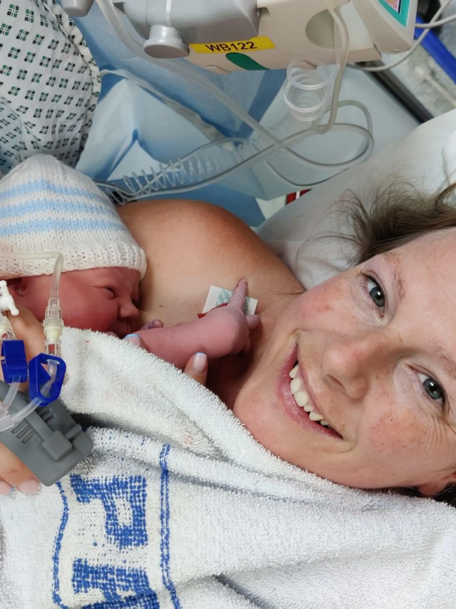 Story from Jam Press (Baby Without Bum) 

Pictured: Vickie after giving birth to her son, Charlie.

Doctors discover rare defect after a baby is born without BUM

A mum has shared the harrowing story of her baby being born without a bum – with the toddler undergoing six life-saving surgeries before his first birthday.

When Vickie Thompson and her fiancé, Alex, 37, gave birth to her son, Charlie, she was over the moon and at first had no idea that anything was amiss.

But just a few hours later, while still in hospital and unable to wake her child, who was in a cot next to her, the mum began to panic.

That’s when medical professionals reportedly discovered the child did not have a bum hole opening and immediately rushed the child to have his stomach pumped.

“I was absolutely petrified... I thought he was dying,” the 36-year-old beauty therapist from West Sussex, told Jam Press.

“The doctors said, ‘We don’t think he has an opening’.

“I was so scared.”

Having fed the newborn just a few hours prior to the shocking discovery, Vickie had also noticed her son had not yet pooped and his pee was a strange green colour.

Upon further investigation, doctors confirmed he had an imperforate anus, the narrowing or absence of the bum, a condition which affects one in 5,000 babies.

Whisking Charlie to the Neonatal Intensive Care Unit (NICU), the doctors removed the contents of his stomach to ensure no toxins remained.

The next day, he was transferred from Worthington Hospital to Brighton Hospital to have a stoma created, placing him under more specialist care.

A stoma is an opening in the abdomen connected to your digestive system, diverting waste away from the bowels and out of the body.

Charlie spent three days in the NICU after the major operation, two of which were in a coma.

The mum said: “I was petrified I was going to lose him.

“They had to put him on life support and I kept thinking he was going to die.

“I kept thinking the worst.”
