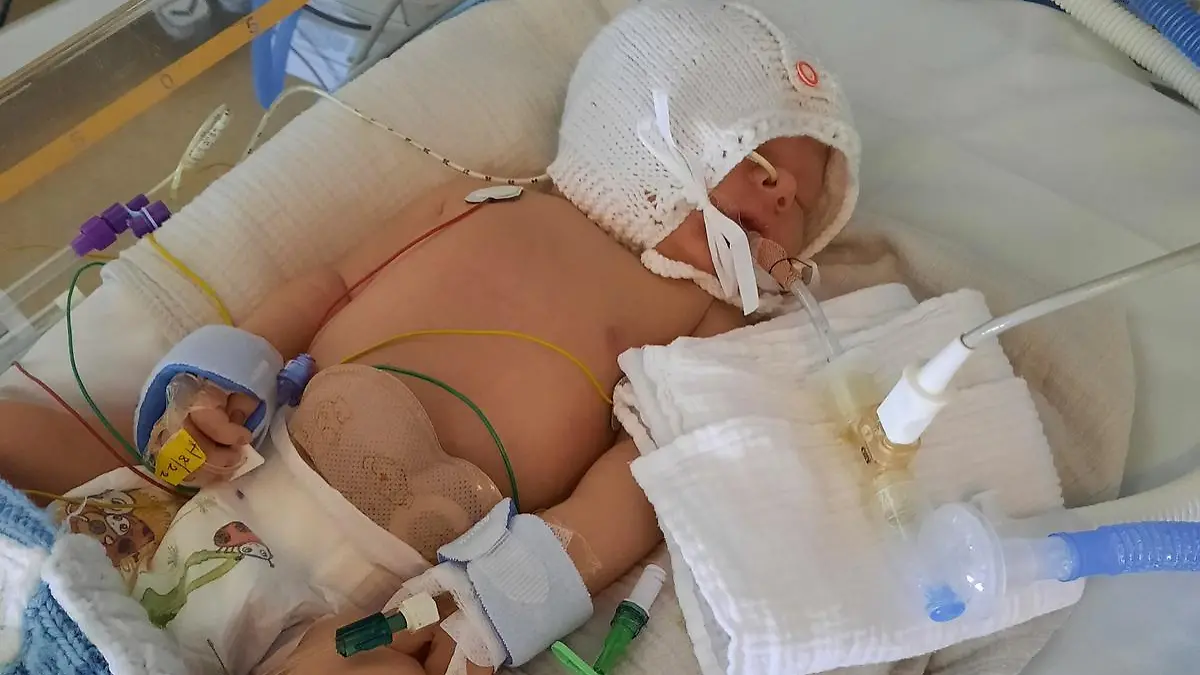 Story from Jam Press (Baby Without Bum) 

Pictured: Charlie in hospital.

Doctors discover rare defect after a baby is born without BUM

A mum has shared the harrowing story of her baby being born without a bum – with the toddler undergoing six life-saving surgeries before his first birthday.

When Vickie Thompson and her fiancé, Alex, 37, gave birth to her son, Charlie, she was over the moon and at first had no idea that anything was amiss.

But just a few hours later, while still in hospital and unable to wake her child, who was in a cot next to her, the mum began to panic.

That’s when medical professionals reportedly discovered the child did not have a bum hole opening and immediately rushed the child to have his stomach pumped.

“I was absolutely petrified... I thought he was dying,” the 36-year-old beauty therapist from West Sussex, told Jam Press.

“The doctors said, ‘We don’t think he has an opening’.

“I was so scared.”

Having fed the newborn just a few hours prior to the shocking discovery, Vickie had also noticed her son had not yet pooped and his pee was a strange green colour.

Upon further investigation, doctors confirmed he had an imperforate anus, the narrowing or absence of the bum, a condition which affects one in 5,000 babies.

Whisking Charlie to the Neonatal Intensive Care Unit (NICU), the doctors removed the contents of his stomach to ensure no toxins remained.

The next day, he was transferred from Worthington Hospital to Brighton Hospital to have a stoma created, placing him under more specialist care.

A stoma is an opening in the abdomen connected to your digestive system, diverting waste away from the bowels and out of the body.

Charlie spent three days in the NICU after the major operation, two of which were in a coma.

The mum said: “I was petrified I was going to lose him.

“They had to put him on life support and I kept thinking he was going to die.

“I kept thinking the worst.”

After seven days, Vickie 
