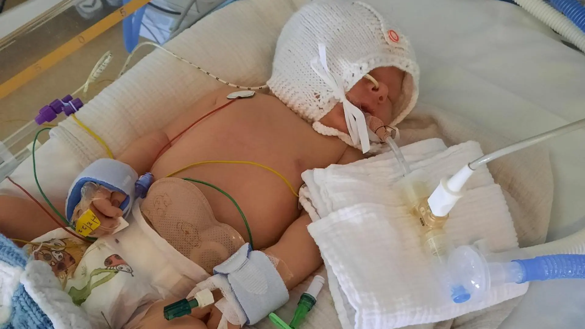 Story from Jam Press (Baby Without Bum)
Pictured: Charlie in hospital.
Doctors discover rare defect after a baby is born without BUM
A mum has shared the harrowing story of her baby being born without a bum – with the toddler undergoing six life-saving surgeries before his first birthday.
When Vickie Thompson and her fiancé, Alex, 37, gave birth to her son, Charlie, she was over the moon and at first had no idea that anything was amiss.
But just a few hours later, while still in hospital and unable to wake her child, who was in a cot next to her, the mum began to panic.
That’s when medical professionals reportedly discovered the child did not have a bum hole opening and immediately rushed the child to have his stomach pumped.
“I was absolutely petrified... I thought he was dying,” the 36-year-old beauty therapist from West Sussex, told Jam Press.
“The doctors said, ‘We don’t think he has an opening’.
“I was so scared.”
Having fed the newborn just a few hours prior to the shocking discovery, Vickie had also noticed her son had not yet pooped and his pee was a strange green colour.
Upon further investigation, doctors confirmed he had an imperforate anus, the narrowing or absence of the bum, a condition which affects one in 5,000 babies.
Whisking Charlie to the Neonatal Intensive Care Unit (NICU), the doctors removed the contents of his stomach to ensure no toxins remained.
The next day, he was transferred from Worthington Hospital to Brighton Hospital to have a stoma created, placing him under more specialist care.
A stoma is an opening in the abdomen connected to your digestive system, diverting waste away from the bowels and out of the body.
Charlie spent three days in the NICU after the major operation, two of which were in a coma.
The mum said: “I was petrified I was going to lose him.
“They had to put him on life support and I kept thinking he was going to die.
“I kept thinking the worst.”
After seven days, Vickie