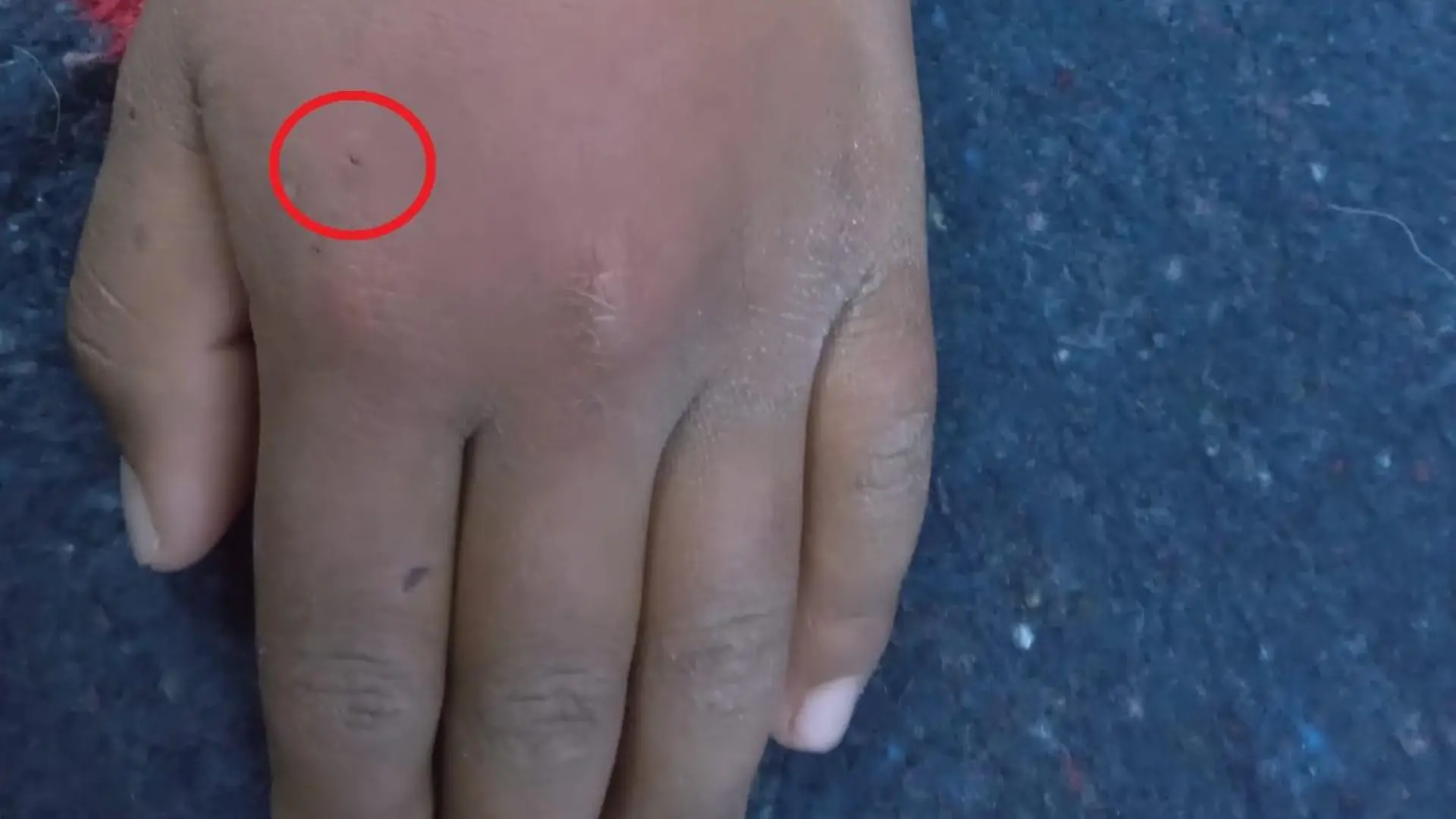 Eine Hand mit einer Bisswunde