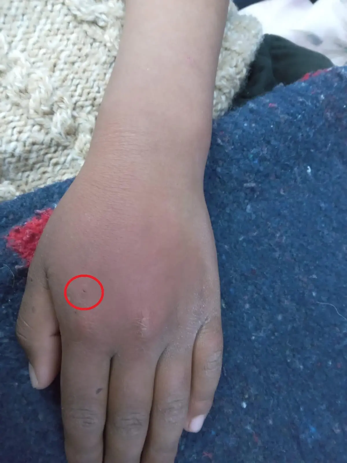 Eine Hand mit einer Bisswunde