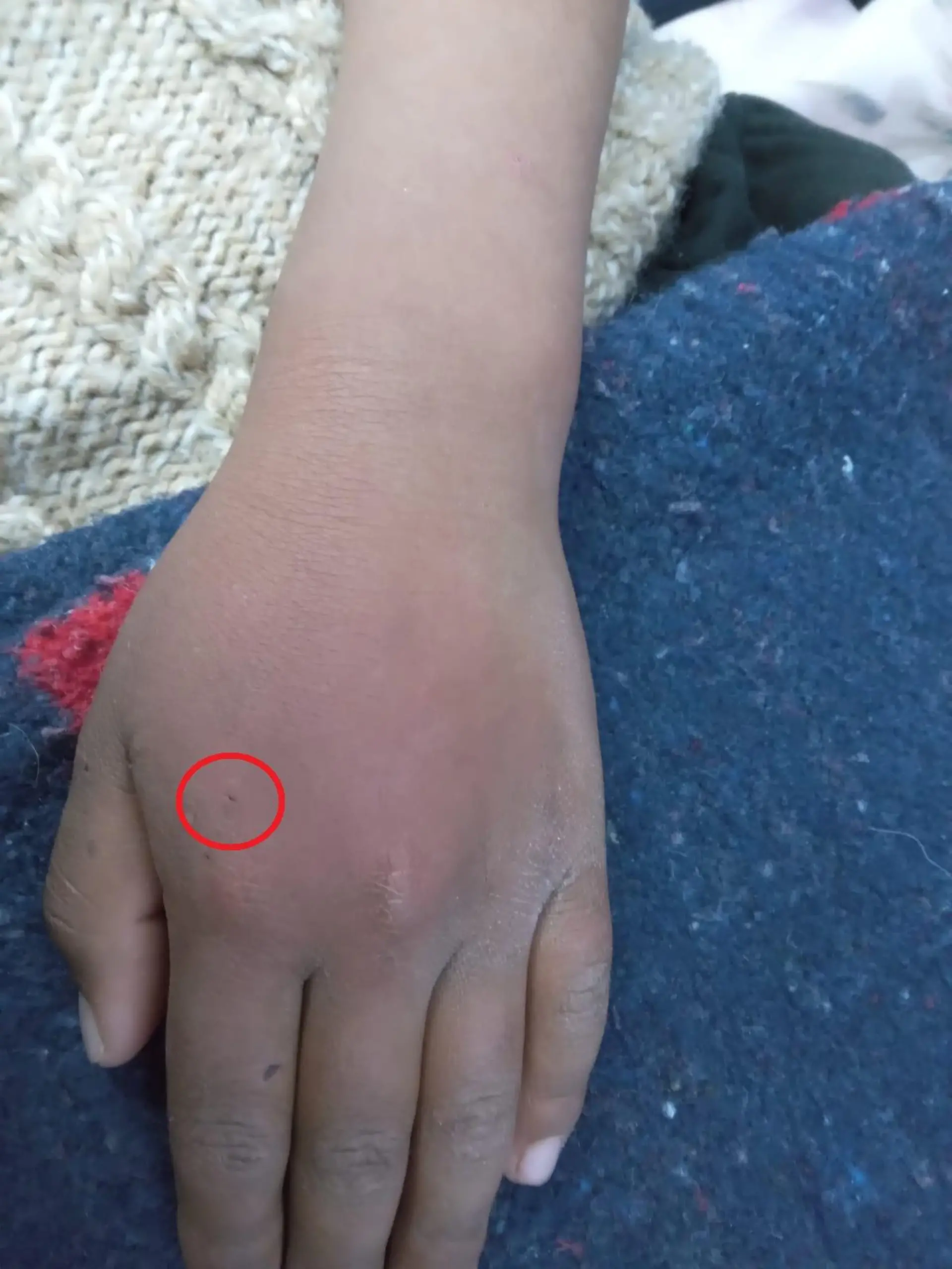 Eine Hand mit einer Bisswunde