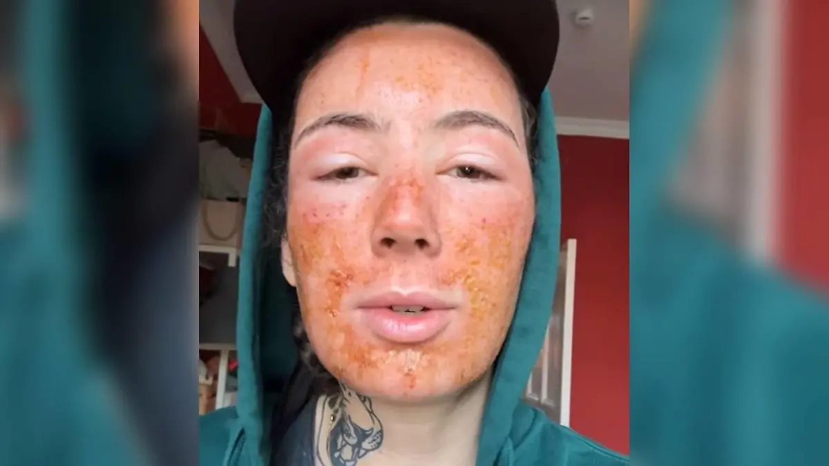 Leila Lowfire nach einer CO2-Laserbehandlung