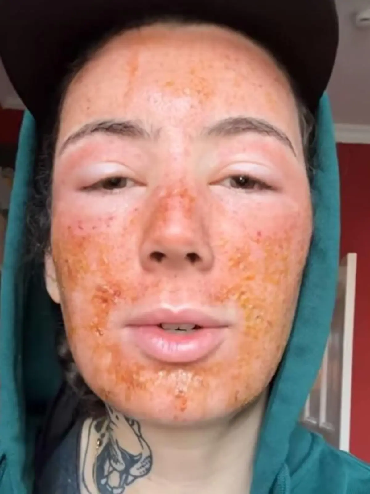 Leila Lowfire nach einer CO2-Laserbehandlung