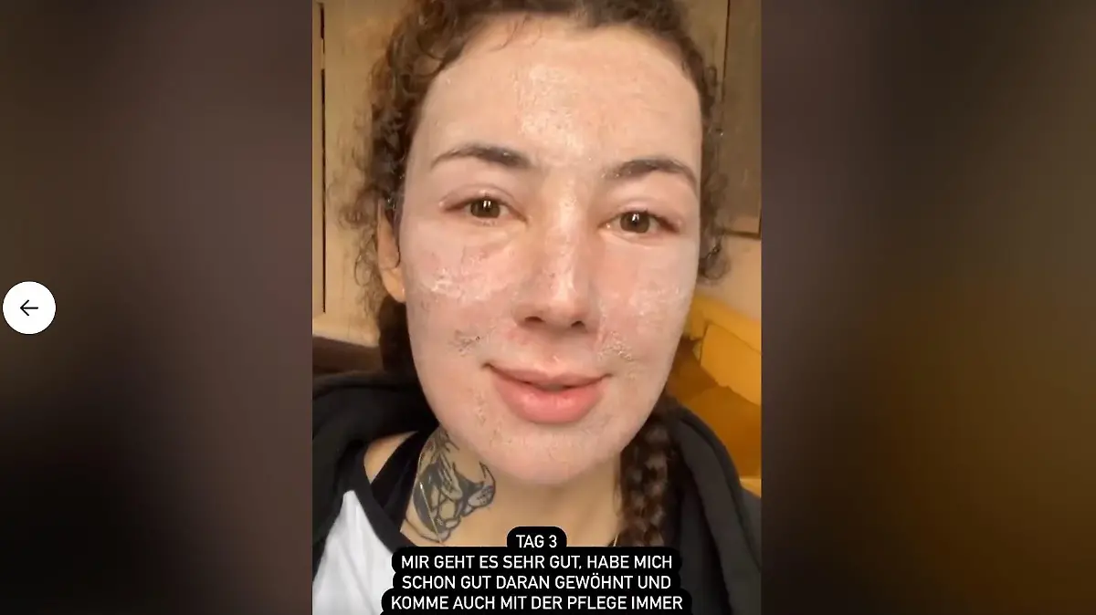 Leila Lowfire: Tag 3 nach der CO2-Laserbehandlung