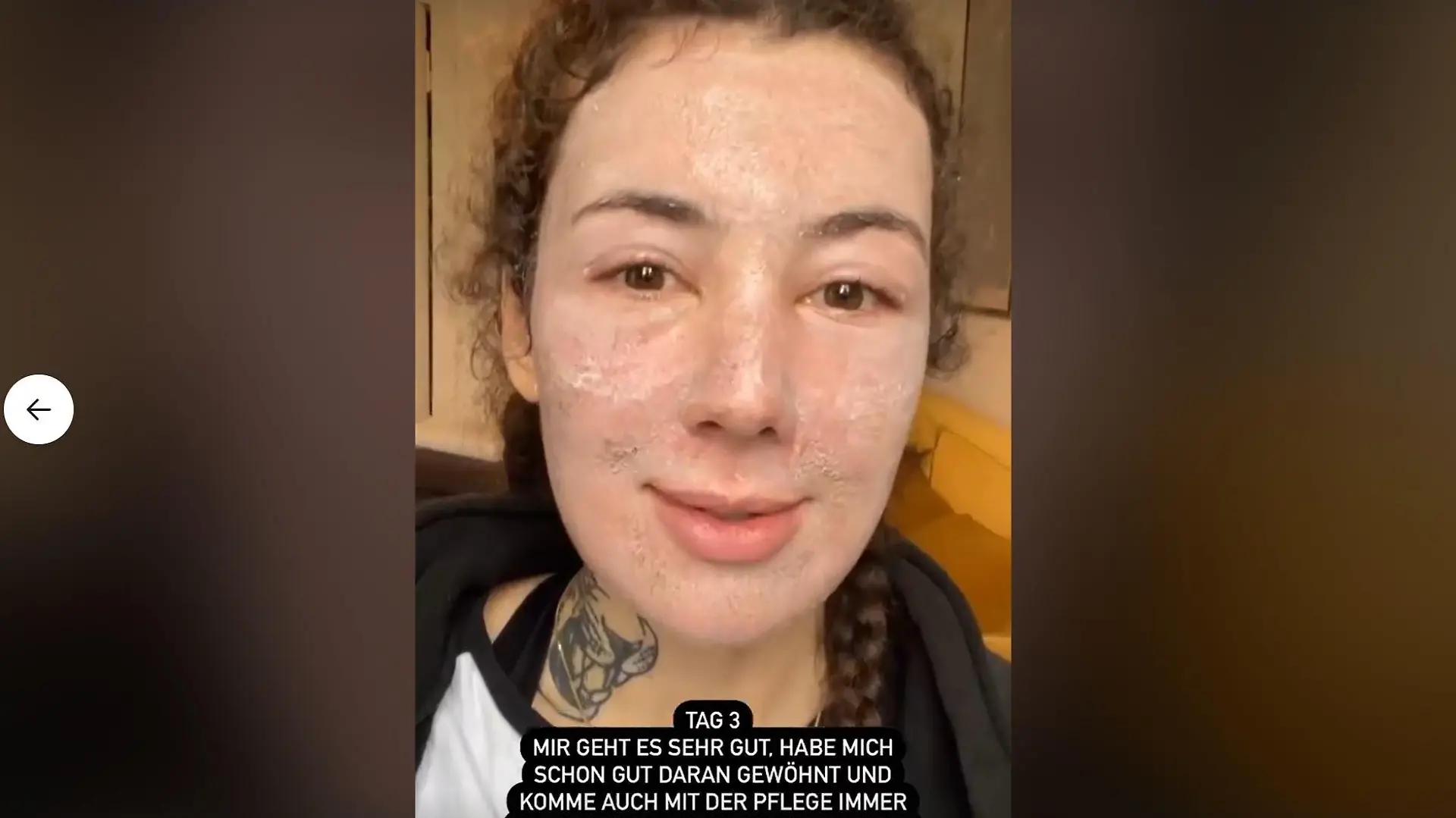 Leila Lowfire: Tag 3 nach der CO2-Laserbehandlung