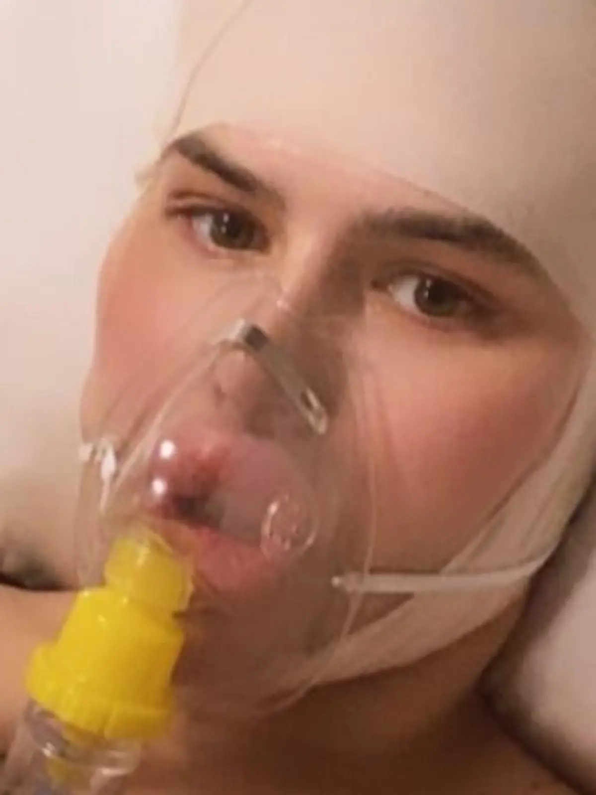 Story from Jam Press (Near Fatal BBL) 

Pictured: Sofia in hospital after going through surgery.

Woman left unable to sit for 15 WEEKS after 'near-fatal' BBL

A model claims she nearly died after spending £12,000 on a BBL in Turkey.

Sofia Lips, 27, a content creator, decided to get a Brazilian butt lift (BBL), wanting to achieve an hourglass shape.

Sofia – who previously made headlines for having Britain’s largest lips – flew to Turkey for the surgery, and claims began vomiting blood once she woke up after the op.

She claims she was flown back to the UK that day, with doctors rushing to drain the dangerous levels of fluid in her body.

Despite the 'near-fatal' incident, she says she would do it again, willing to risk her life to achieve the perfect body.

“The surgery itself went amazing, but I woke up after surgery throwing up blood,” Sofia, from Manchester, told NeedToKnow.co.uk.

“I instantly had to go to the airport because Turkey went into a red zone due to Covid in May 2021.

“There were no drains in my butt, so all the fluid was building up in me.

“The fluid was a build-up of pure blood because, after a BBL, you are fitted with drains for at least a few days, but I was woken up with nothing, no drains, no aftercare just in a faja [compression suit] being sent to an airport.

“I was totally on my own for the flight, everything.

“Just standing up was hard... I was so faint.

“I had a BBL pillow I had to sit on during take-off, then I stood the whole flight, crying behind my sunglasses until landing, [when I] sat back on my BBL pillow.

“Once I landed, I was so weak and fainting.

“I went straight home and started filling with fluid in my butt again, so I had to go to surgery at a hospital to drain it.”

After spending £2,000 to get home, Sofia was instantly rushed into surgery to drain the build-up of fluid.

Following the initial drain, she had to visit the doctors to be drained once a week for 11 weeks, each time costing he