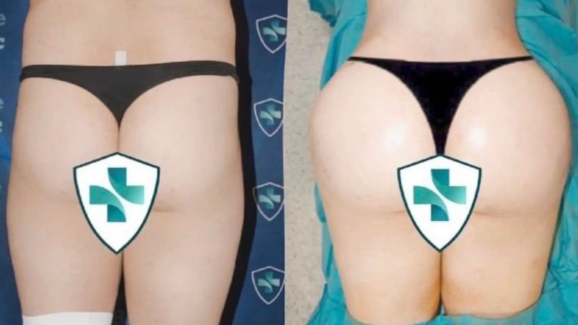 Story from Jam Press (Near Fatal BBL) 

Pictured: Sofia’s butt before and after a BBL.

Woman left unable to sit for 15 WEEKS after 'near-fatal' BBL

A model claims she nearly died after spending £12,000 on a BBL in Turkey.

Sofia Lips, 27, a content creator, decided to get a Brazilian butt lift (BBL), wanting to achieve an hourglass shape.

Sofia – who previously made headlines for having Britain’s largest lips – flew to Turkey for the surgery, and claims began vomiting blood once she woke up after the op.

She claims she was flown back to the UK that day, with doctors rushing to drain the dangerous levels of fluid in her body.

Despite the 'near-fatal' incident, she says she would do it again, willing to risk her life to achieve the perfect body.

“The surgery itself went amazing, but I woke up after surgery throwing up blood,” Sofia, from Manchester, told NeedToKnow.co.uk.

“I instantly had to go to the airport because Turkey went into a red zone due to Covid in May 2021.

“There were no drains in my butt, so all the fluid was building up in me.

“The fluid was a build-up of pure blood because, after a BBL, you are fitted with drains for at least a few days, but I was woken up with nothing, no drains, no aftercare just in a faja [compression suit] being sent to an airport.

“I was totally on my own for the flight, everything.

“Just standing up was hard... I was so faint.

“I had a BBL pillow I had to sit on during take-off, then I stood the whole flight, crying behind my sunglasses until landing, [when I] sat back on my BBL pillow.

“Once I landed, I was so weak and fainting.

“I went straight home and started filling with fluid in my butt again, so I had to go to surgery at a hospital to drain it.”

After spending £2,000 to get home, Sofia was instantly rushed into surgery to drain the build-up of fluid.

Following the initial drain, she had to visit the doctors to be drained once a week for 11 weeks, each time costing her £150.