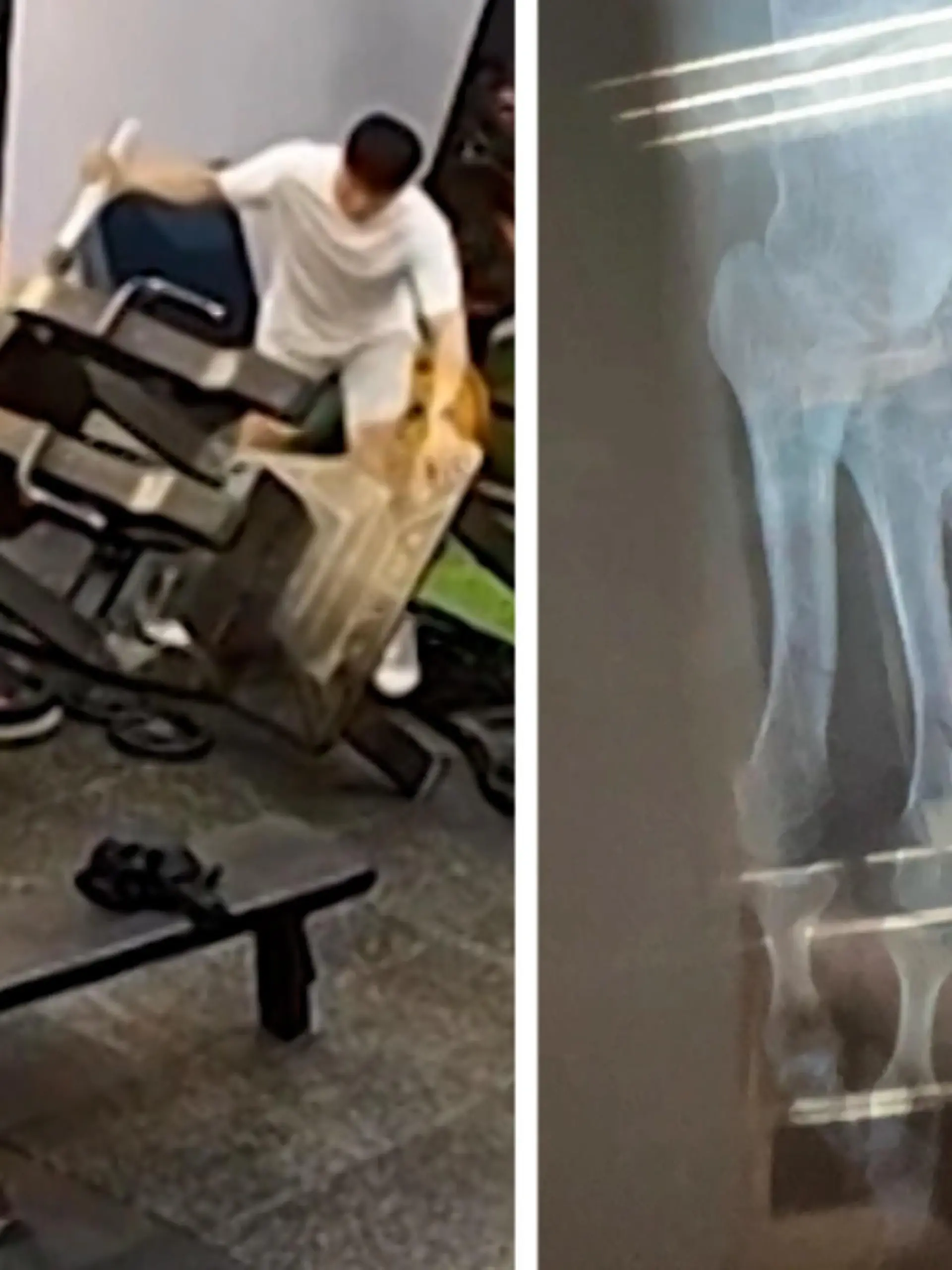 Eine Frau verletzt sich im Fitnessstudio schwer, als sie von einem Gerät erfasst wird. Sie bricht sich bei dem Vorfall mehrere Knochen. Warum es jedoch nicht nur schlechte Nachrichten für sie gibt, erfahren Sie im Video!