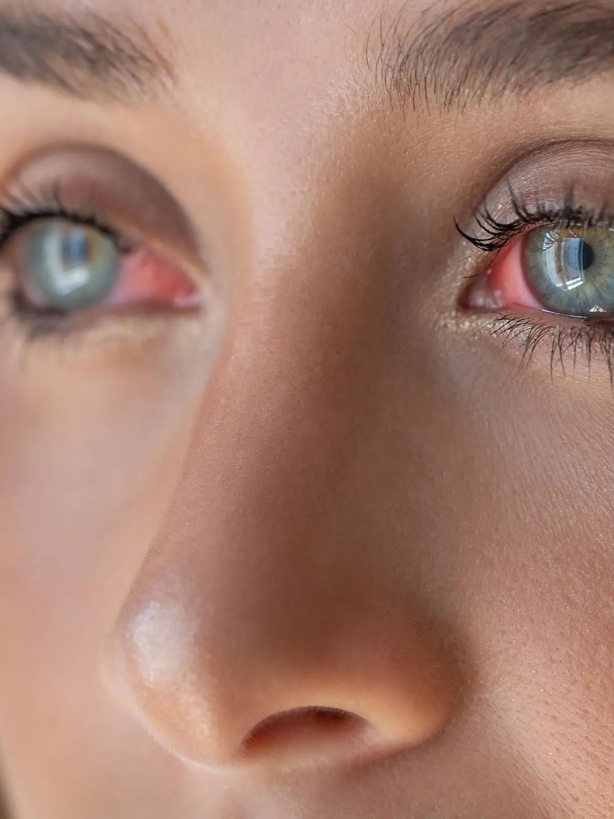 Red eye suffering from allergy
