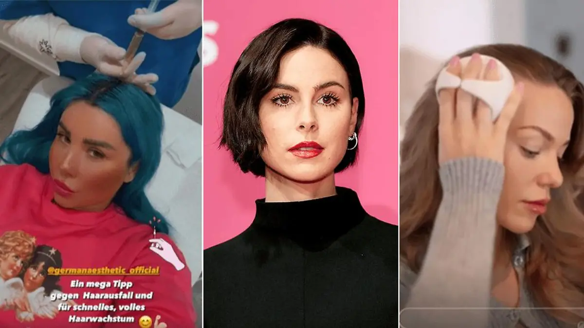 Kate Merlan, Lena Meyer-Landrut und Laura Maria Rypa haben alle mit Haarausfall zu kämpfen.