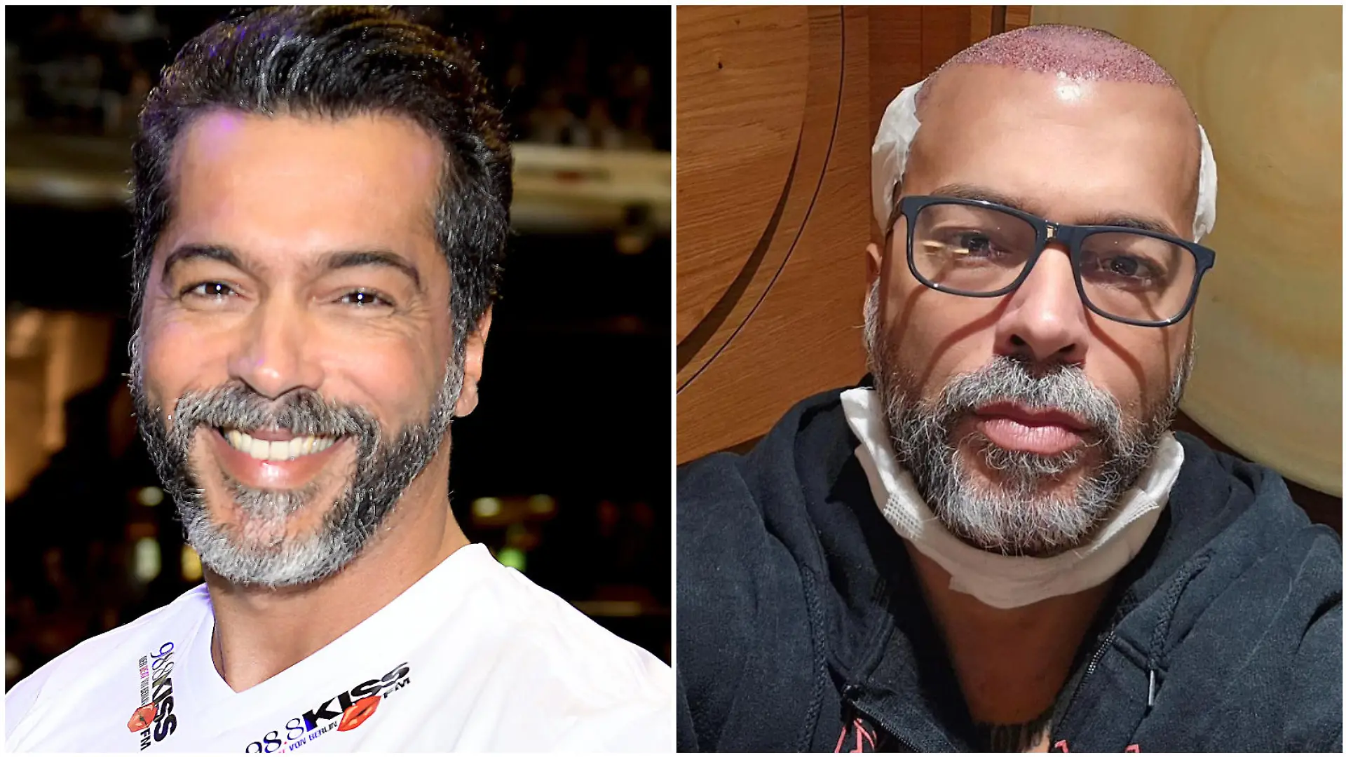 Aurelio Savina mit Haaren und nach der Haartransplantation (Collage)