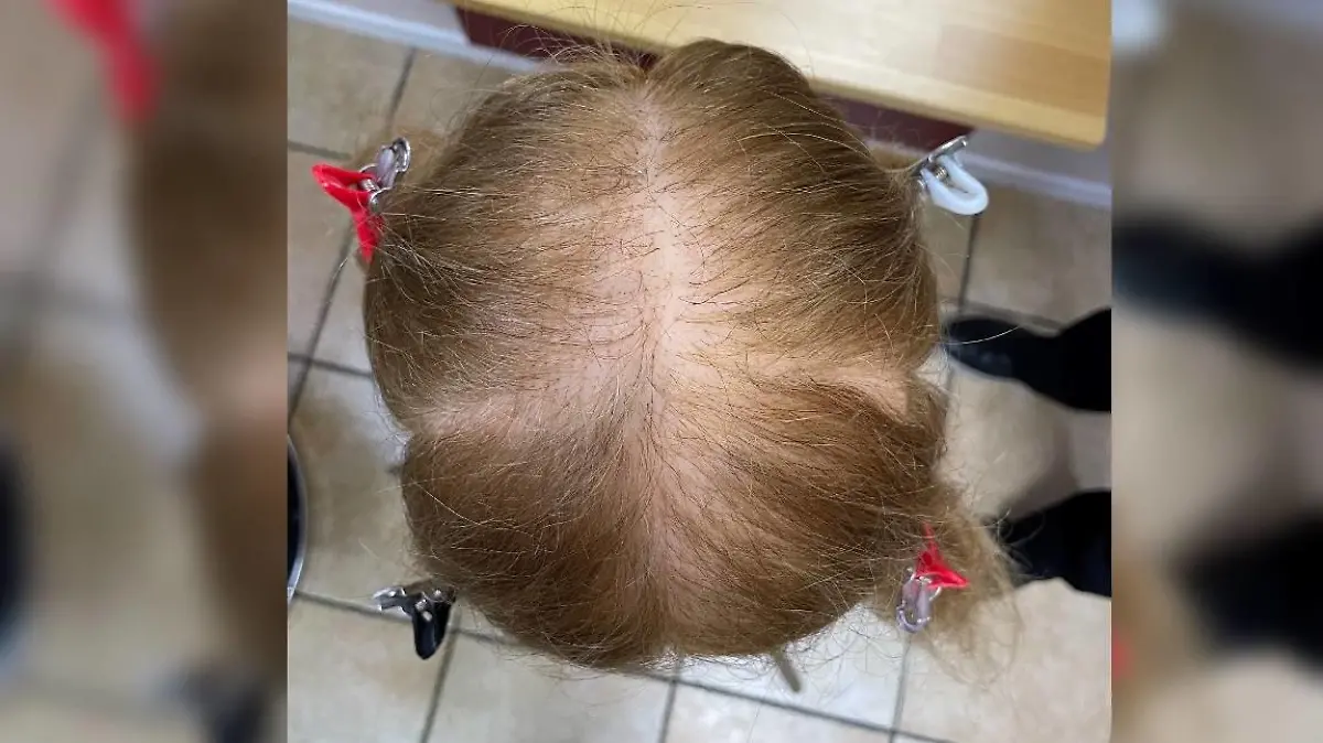 Puppe diffuser Haarausfall