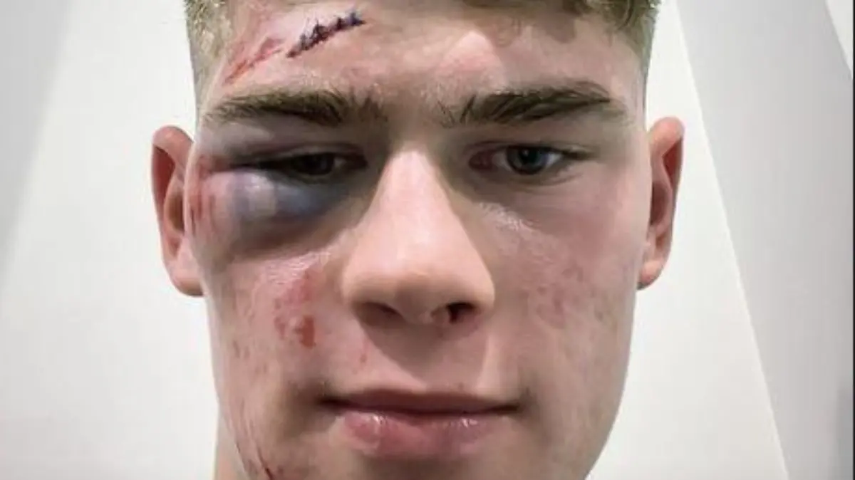 Charlie Cresswell nach Horror-Foul in Englands zweiter Liga