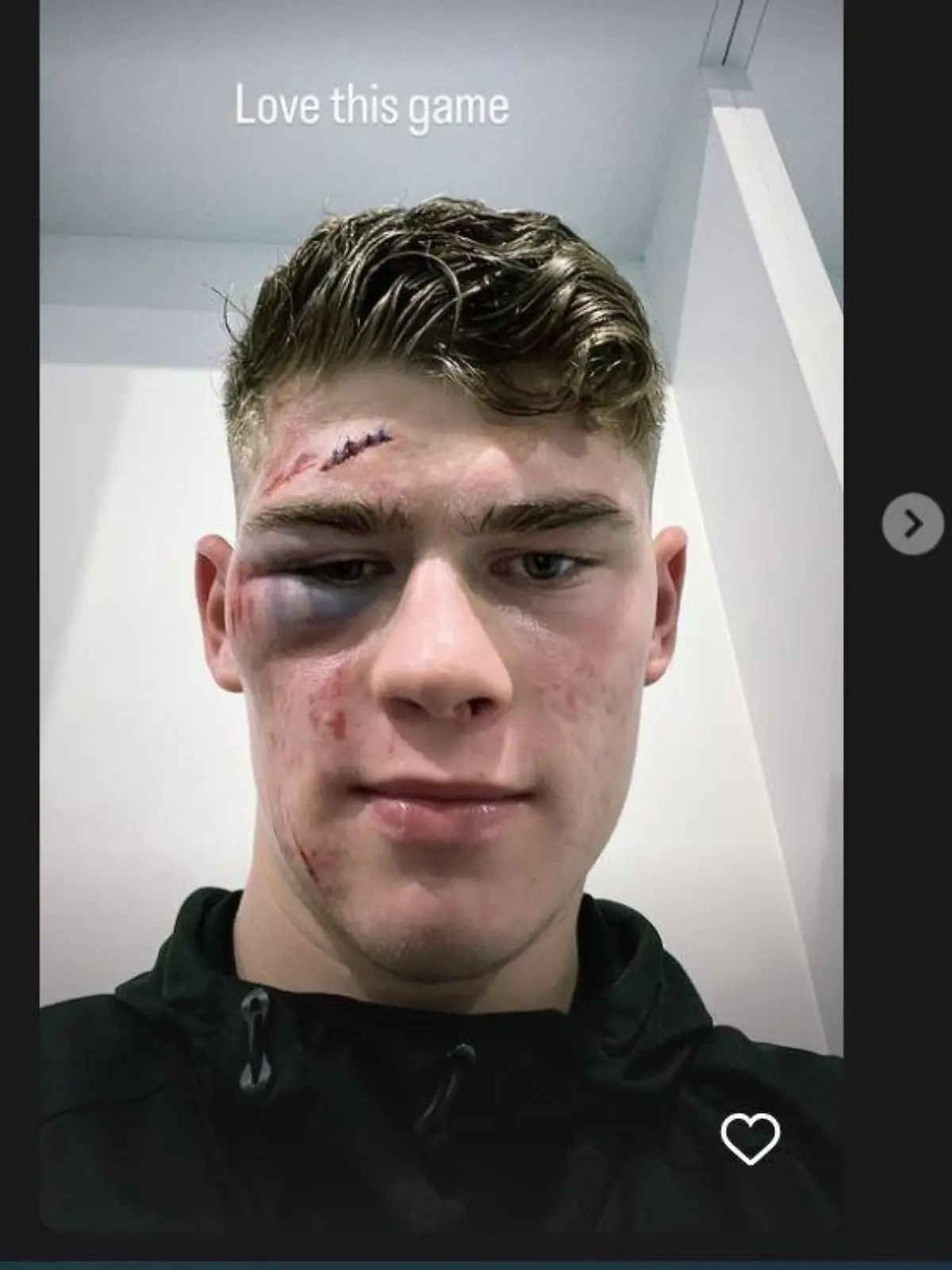 Charlie Cresswell nach Horror-Foul in Englands zweiter Liga