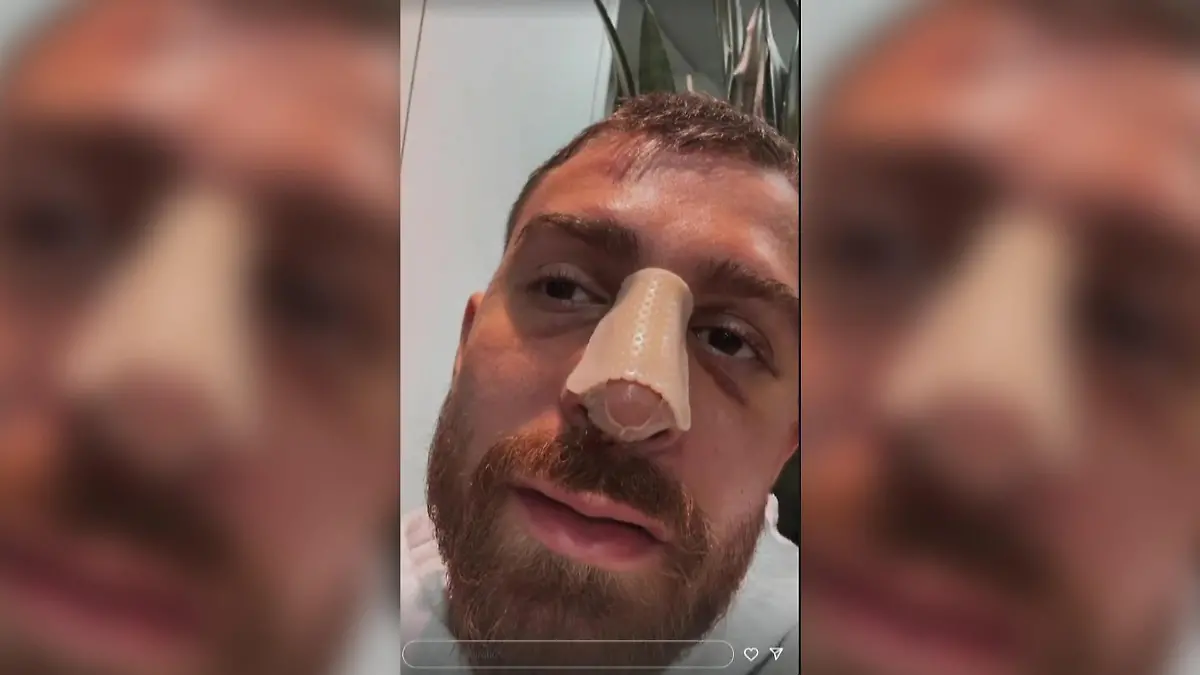 Gigi Birofio musste sich nach dem Boxkampf einer Nasen-Op unterziehen.