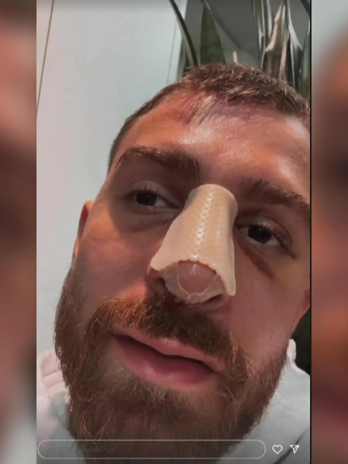 Gigi Birofio musste sich nach dem Boxkampf einer Nasen-Op unterziehen.