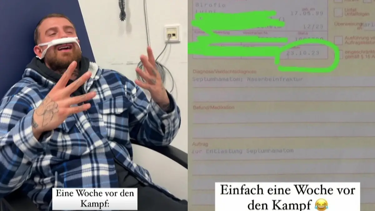Schon eine Woche vor dem Kampf hatte sich Gigi Birofio eine Nasenfraktur zugezogen.
