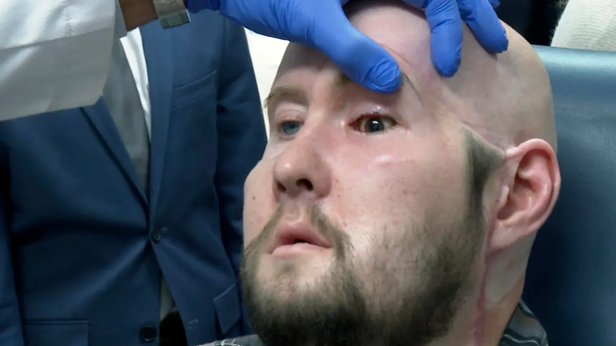 Dr. Eduardo Rodriguez, NYU Langone Health's chair of plastic surgery, examines Aaron James in New York on Oct. 23, 2023. In May 2023, surgeons performed the world’s first transplant of an entire human eye, an extraordinary addition to a face transplant _ although it’s far too soon to know if the man will ever see through his new left eye. “It feels good. I still don’t have any movement in it yet. My eyelid, I can’t blink yet. But I’m getting sensation now,” James said in October. (AP Photo/Joseph. B. Frederick)