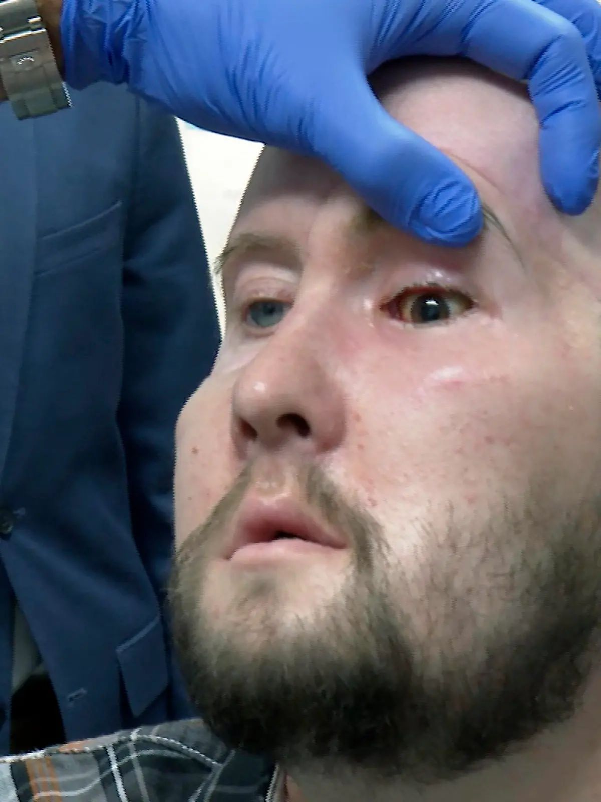 Dr. Eduardo Rodriguez, NYU Langone Health's chair of plastic surgery, examines Aaron James in New York on Oct. 23, 2023. In May 2023, surgeons performed the world’s first transplant of an entire human eye, an extraordinary addition to a face transplant _ although it’s far too soon to know if the man will ever see through his new left eye. “It feels good. I still don’t have any movement in it yet. My eyelid, I can’t blink yet. But I’m getting sensation now,” James said in October. (AP Photo/Joseph. B. Frederick)
