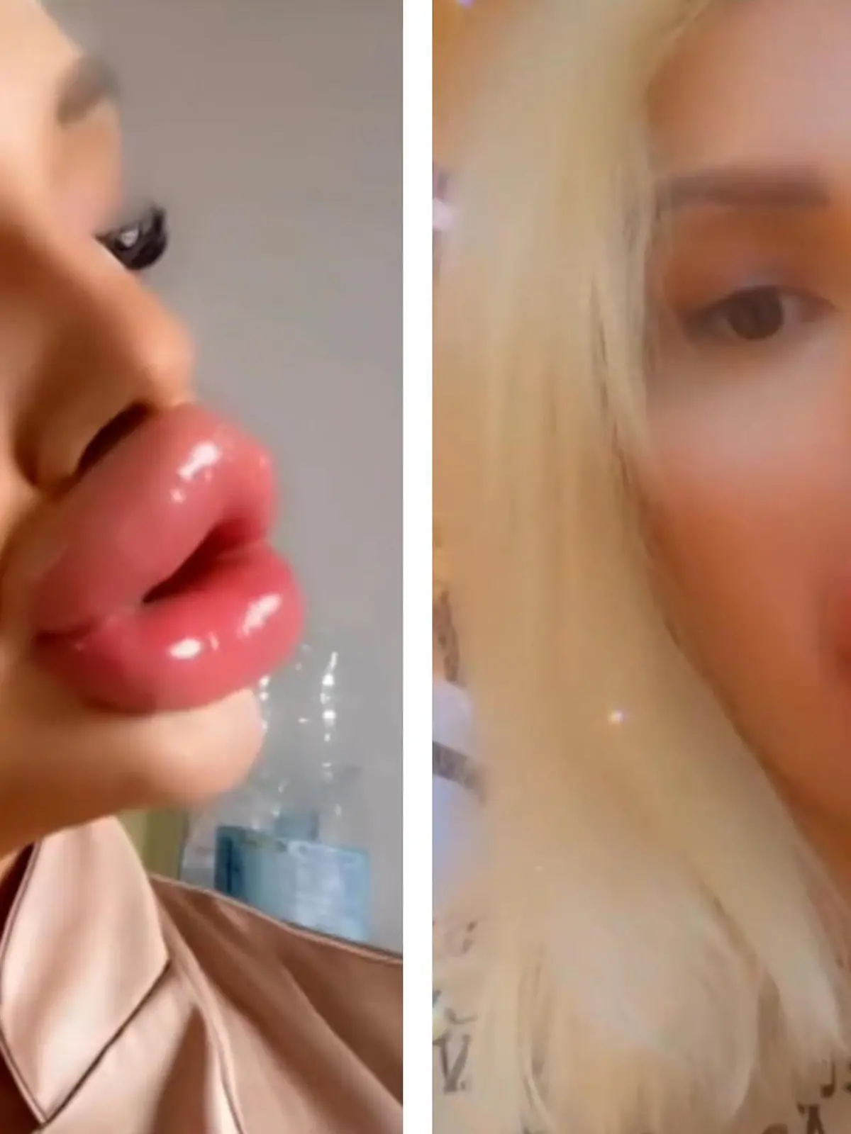 Die Lippen von Influencerin Vienna Würstel wachsen gerade etwas über ihr Ziel hinaus. Die Österreicherin pumpt nämlich regelmäßig Lippfiller hinein! Essen und trinken gestalten sich da mittlerweile echt schwierig. Doch für Vienna ist noch lange nicht Schluss!