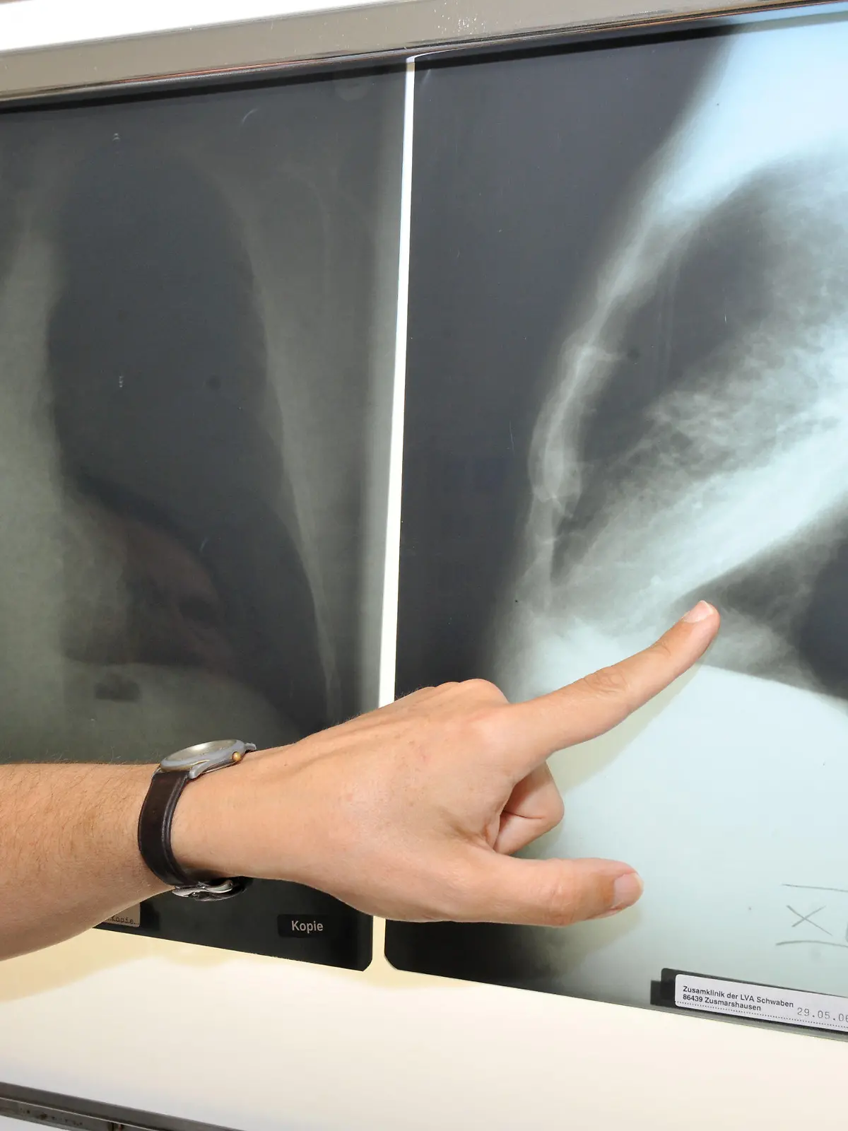 ACHTUNG: DIESER BEITRAG DARF NICHT VOR ABLAUF DER SPERRFRIST, 3. NOVEMBER, 20.00 UHR, VERÖFFENTLICHT WERDEN! DIE NICHTEINHALTUNG DES EMBARGOS HÄTTE EMPFINDLICHE EINSCHRÄNKUNGEN DER BERICHTERSTATTUNG ÜBER WISSENSCHAFTLICHE STUDIEN ZUR FOLGE. Die Hand des Leiters der Pneumologie (Lungenheilkunde) Prof.Dr.med. Rudolf Maria Huber zeigt am 17.06.2010 in München (Oberbayern) im Klinikum der Universität München, Medizinische Klinik - Innenstadt, auf ein Röntgenbild einer mit Krebs befallenen Lunge. Foto: Felix Hörhager dpa/lby (Zu dpa "Forscher entschlüsseln mutiertes Erbgut in Tumoren von Rauchern" vom 03.11.2016) +++(c) dpa - Bildfunk+++