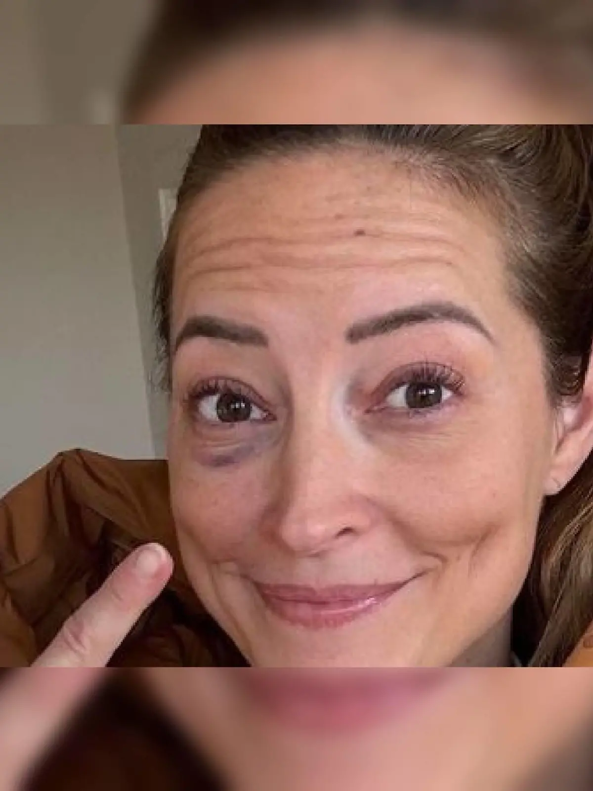 Anna Fleischhauer zeigt ihr blaues Auge auf Instagram