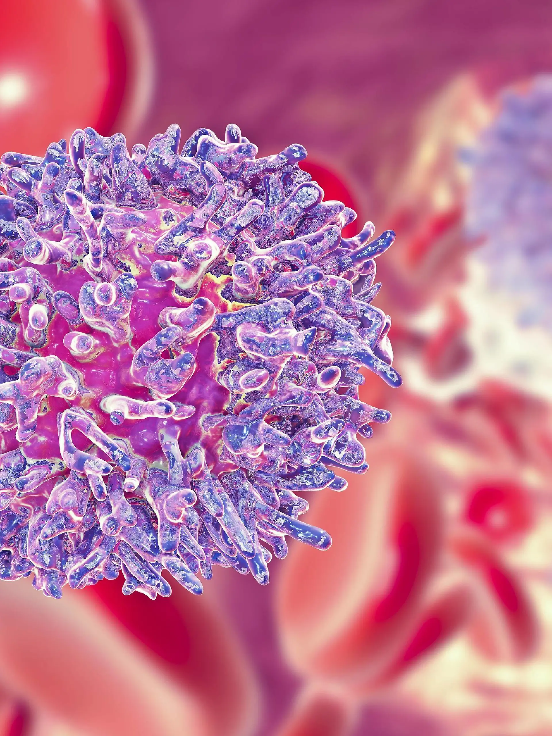  Lymphocyte in hairy cell leukaemia, illustration Hairy cell leukaemia. Computer illustration of abnormal white blood cell B- lymphocyte from a patient with hairy cell leukaemia. These cells show characteristic hair-like cytoplasmic projections and ruffles on their surfaces. Leukaemia is a blood cancer in which the blood-producing tissue in bone marrow produces excessive numbers of immature white blood cells, as seen here, which impair the function of normal blood cells. The immune system is thus weakened. Hairy cell leukaemia is a rare form of leukaemia that mostly affects men. Most patients survive for five years or more after diagnosis. PUBLICATIONxINxGERxSUIxHUNxONLY KATERYNAxKON/SCIENCExPHOTOxLIBRARY F022/4387