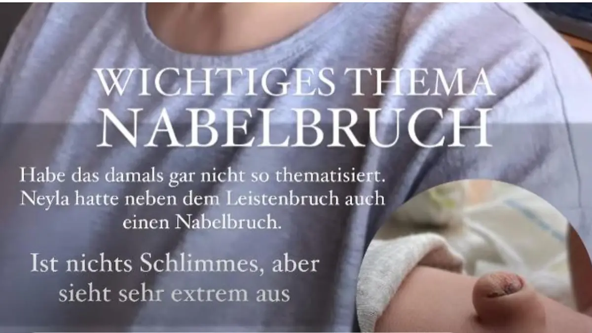 Fiona Erdmann zeigt den Nabelbruch ihrer Tochter.