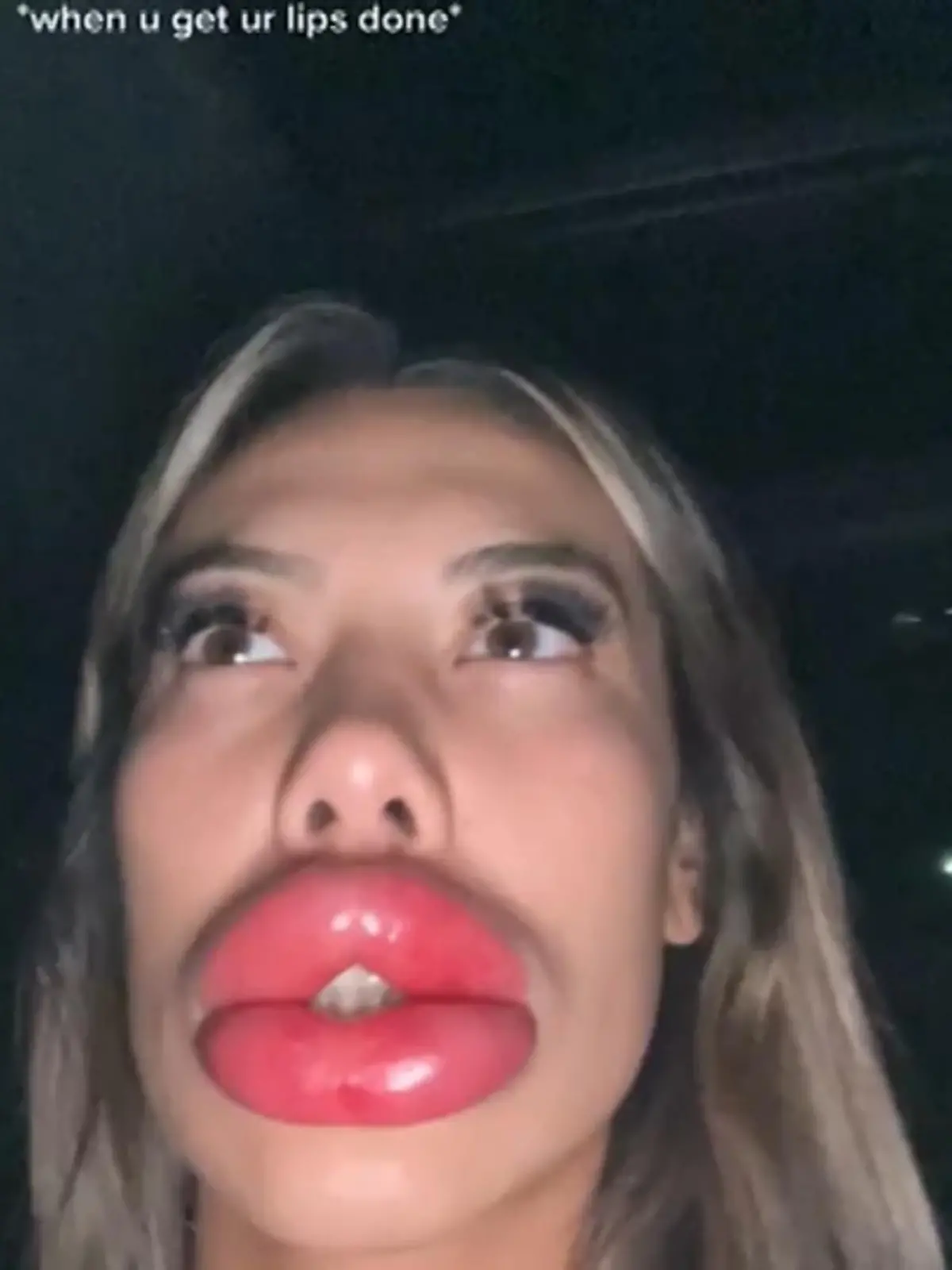Das ist wirklich bitter! Basia Query hat auf dem Foto ziemlich dicke Lippen. Eigentlich wollte die Influencerin nur etwas betontere Lippen und ging zum Schönheitschirurgen. Doch dann wurde der Eingriff zum Albtraum.
