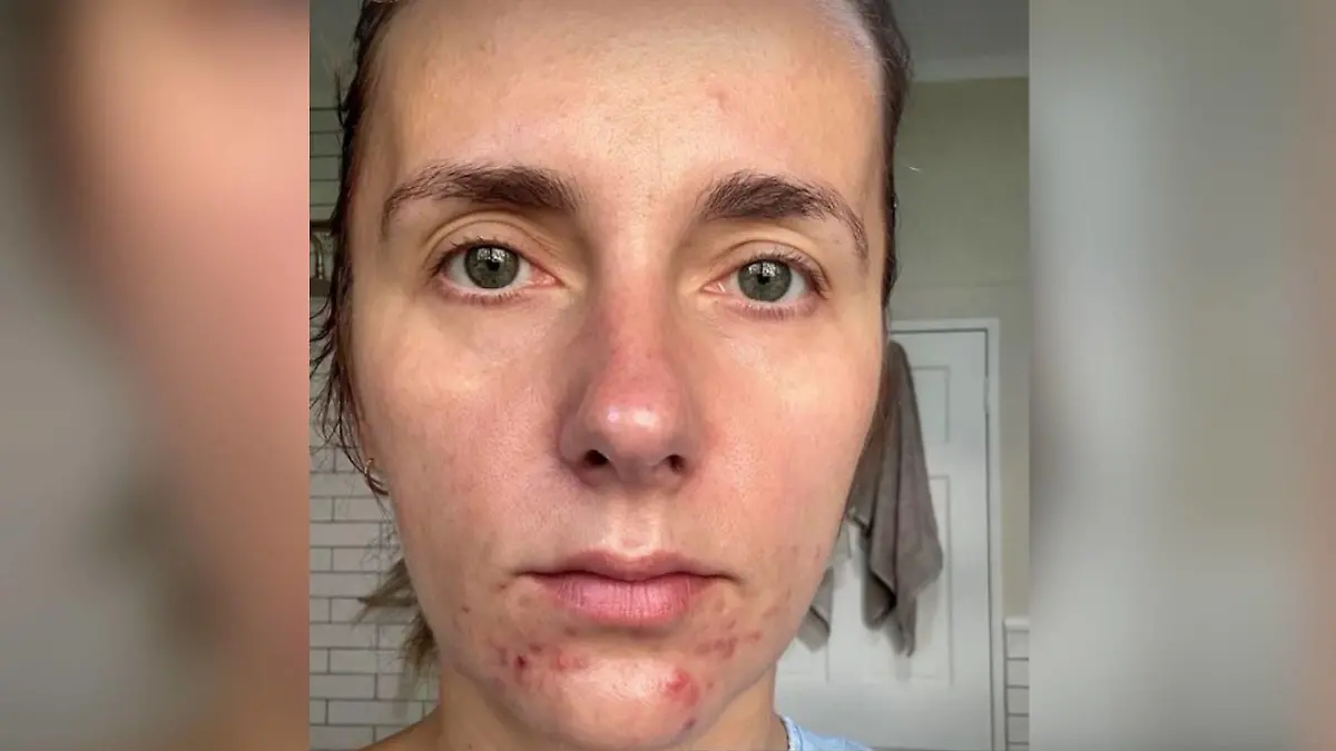 Anna Heiser leidet unter starker Akne
