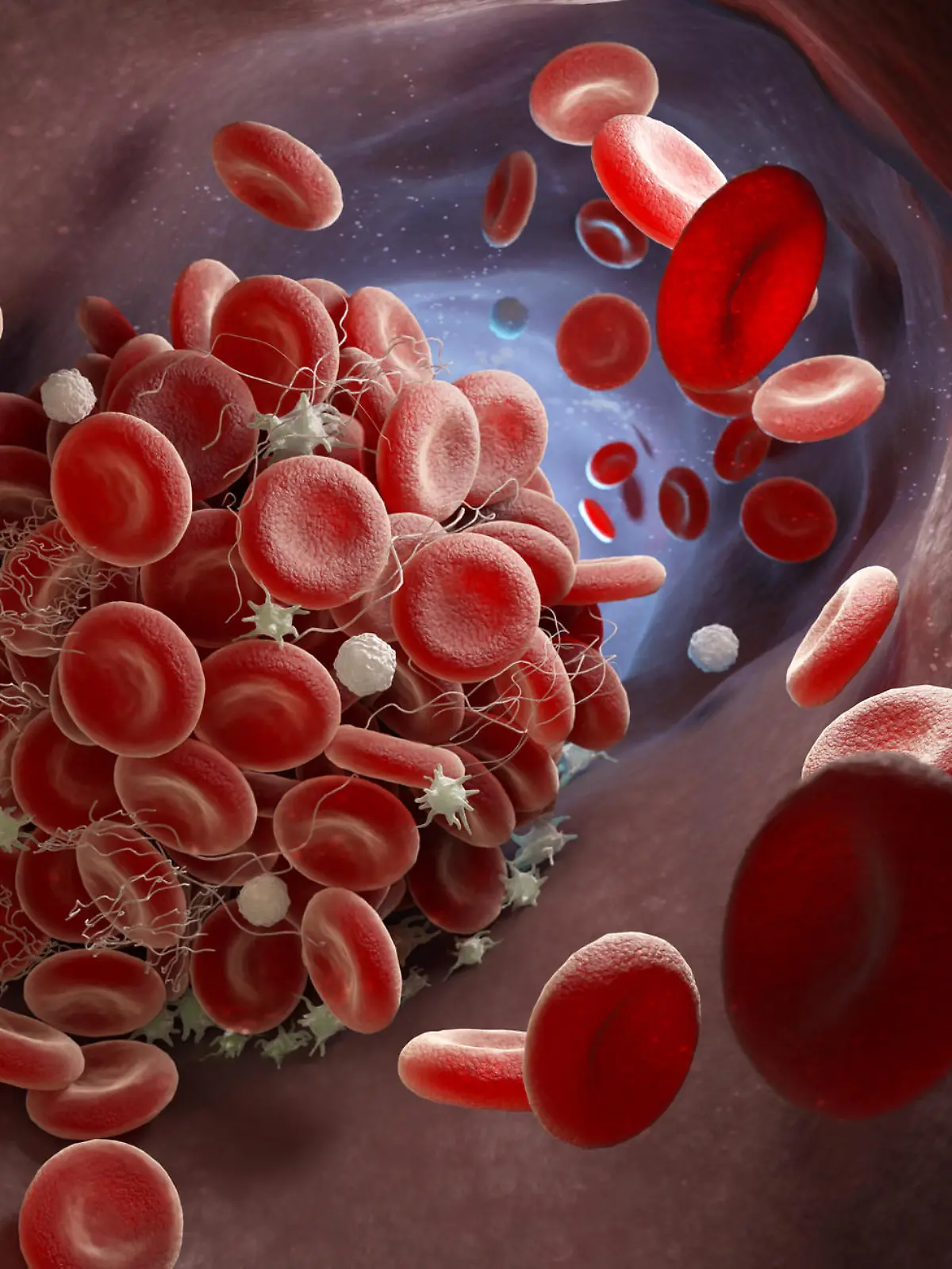 Depiction of a blood clot forming inside a blood vessel. 3D illustration