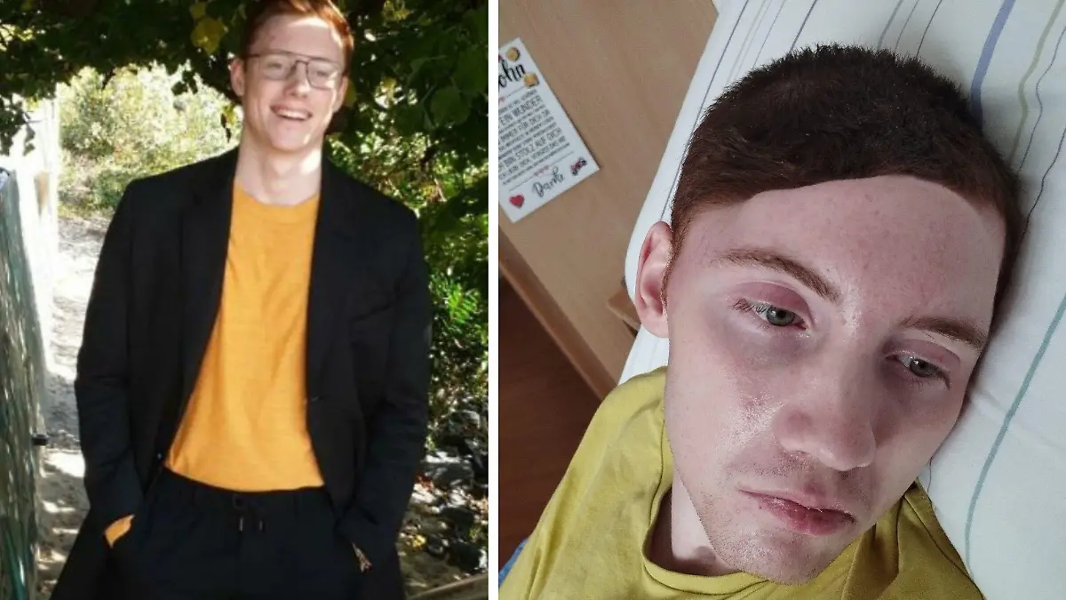 Nico vor und nach seinem schweren Motorrad-Unfall