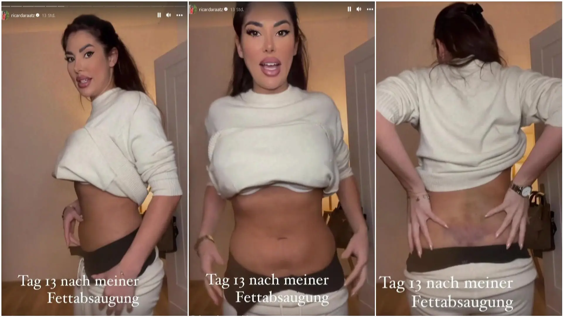 Ricarda Raatz zeigt ihren Bauch nach der Fettabsaugung
