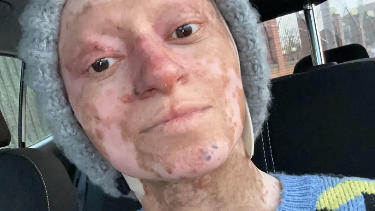 Story from Jam Press (Traumatic Skin Condition) 

Pictured: Assya Shabir.

‘I have rare butterfly skin condition – trolls say I look like Freddy Krueger’

A woman who suffers from an incurable condition says her skin is as “fragile as butterfly wings”.

Assya Shabir, from Birmingham, was born with junctional epidermolysis bullosa (JEB) – a form of EB that describes a group of genetic conditions that affect a person’s skin.

The 36-year-old often has to deal with blistering, open wounds, skin loss, friction and irritation – heavily impacting her day-to-day life.

She is often “judged or ignored” by strangers and is in and out of the hospital for treatment.

“My skin is as fragile as a butterfly’s wings,” Assya, who shared her journey on Instagram with her 10,900 followers (@assyaebqueeen), told NeedToKnow.co.uk.

“The slightest grip or even a bump can blister and graze my skin.

“It’s not just external; I get blistering in my oesophageal system, eyes, mouth, gums and other areas too.

“Living with JEB is complicated at the best of times, it doesn’t just affect me physically but mentally and emotionally too.

“It is hard to find genuine friendships and relationships.

“Some people don’t acknowledge me – they’ll judge or ignore me.”

Sadly Assya also has to put up people staring or making faces.

She said: “Most of the time I try not to react or even respond.

“But when I’m going through a flare-up and I’m already feeling worse because the pain is unbearable and I’m already feeling useless as it is, their looks hit hard and just make me feel like s**t.

“I’m sure you can imagine the kinds of comments I get too.

“Ironically it’s from adults more than kids – yes of course kids comment but they’re not aware of why I look different, I always say kids are very innocent.

“One of the worst ones I’ve had face to face is ‘you look like Freddie Kruger’ and ‘your mum should have aborted you’.

�