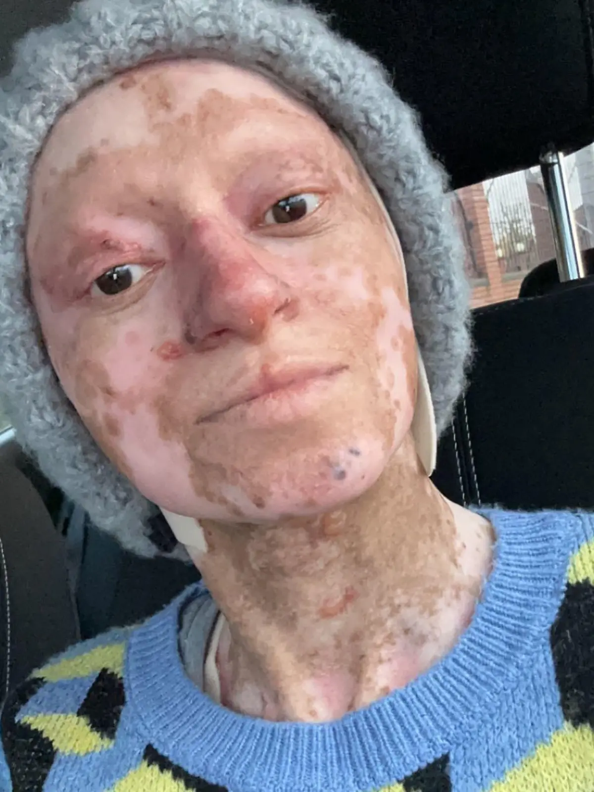Story from Jam Press (Traumatic Skin Condition) 

Pictured: Assya Shabir.

‘I have rare butterfly skin condition – trolls say I look like Freddy Krueger’

A woman who suffers from an incurable condition says her skin is as “fragile as butterfly wings”.

Assya Shabir, from Birmingham, was born with junctional epidermolysis bullosa (JEB) – a form of EB that describes a group of genetic conditions that affect a person’s skin.

The 36-year-old often has to deal with blistering, open wounds, skin loss, friction and irritation – heavily impacting her day-to-day life.

She is often “judged or ignored” by strangers and is in and out of the hospital for treatment.

“My skin is as fragile as a butterfly’s wings,” Assya, who shared her journey on Instagram with her 10,900 followers (@assyaebqueeen), told NeedToKnow.co.uk.

“The slightest grip or even a bump can blister and graze my skin.

“It’s not just external; I get blistering in my oesophageal system, eyes, mouth, gums and other areas too.

“Living with JEB is complicated at the best of times, it doesn’t just affect me physically but mentally and emotionally too.

“It is hard to find genuine friendships and relationships.

“Some people don’t acknowledge me – they’ll judge or ignore me.”

Sadly Assya also has to put up people staring or making faces.

She said: “Most of the time I try not to react or even respond.

“But when I’m going through a flare-up and I’m already feeling worse because the pain is unbearable and I’m already feeling useless as it is, their looks hit hard and just make me feel like s**t.

“I’m sure you can imagine the kinds of comments I get too.

“Ironically it’s from adults more than kids – yes of course kids comment but they’re not aware of why I look different, I always say kids are very innocent.

“One of the worst ones I’ve had face to face is ‘you look like Freddie Kruger’ and ‘your mum should have aborted you’.

�