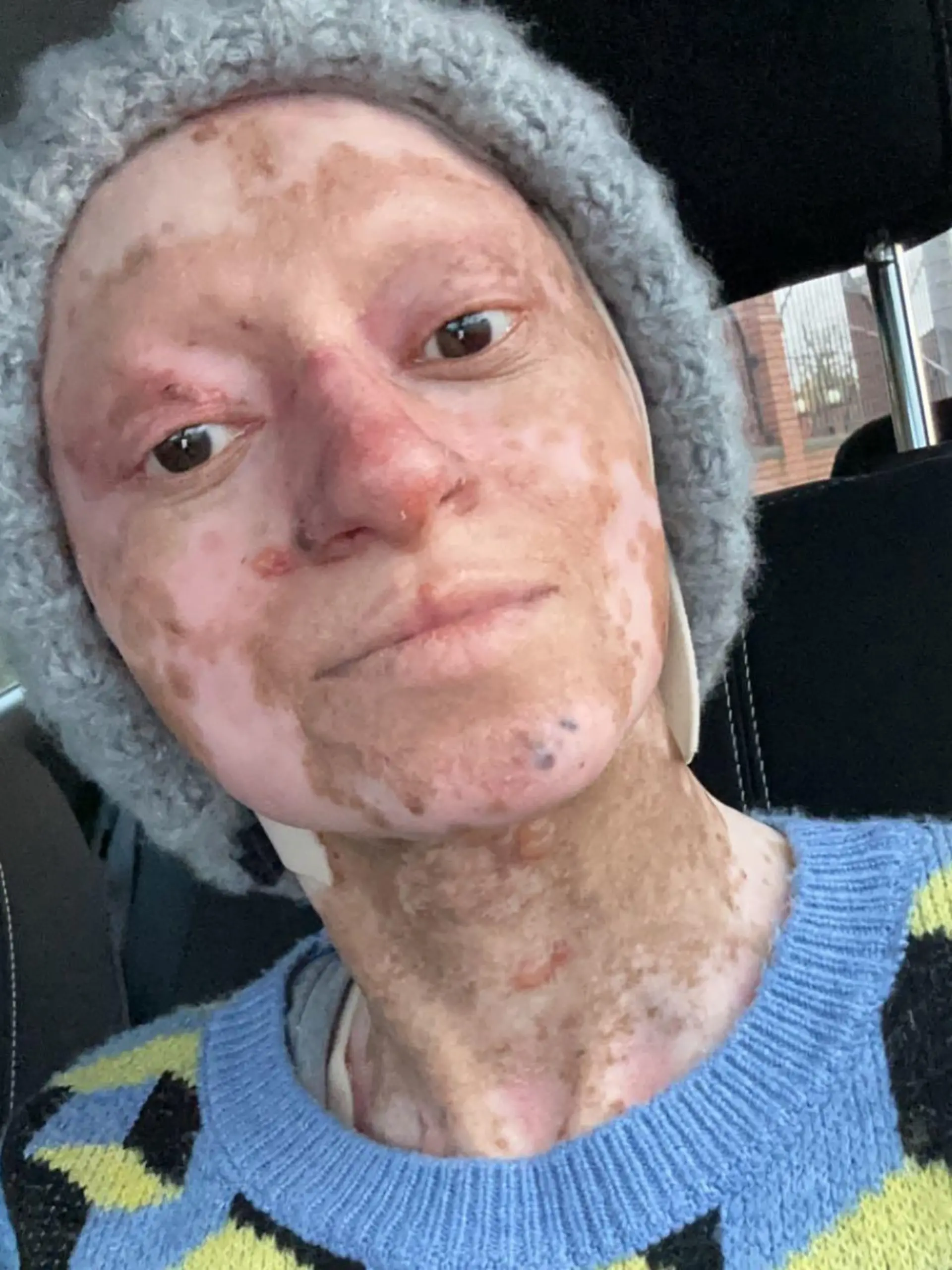 Story from Jam Press (Traumatic Skin Condition) 

Pictured: Assya Shabir.

‘I have rare butterfly skin condition – trolls say I look like Freddy Krueger’

A woman who suffers from an incurable condition says her skin is as “fragile as butterfly wings”.

Assya Shabir, from Birmingham, was born with junctional epidermolysis bullosa (JEB) – a form of EB that describes a group of genetic conditions that affect a person’s skin.

The 36-year-old often has to deal with blistering, open wounds, skin loss, friction and irritation – heavily impacting her day-to-day life.

She is often “judged or ignored” by strangers and is in and out of the hospital for treatment.

“My skin is as fragile as a butterfly’s wings,” Assya, who shared her journey on Instagram with her 10,900 followers (@assyaebqueeen), told NeedToKnow.co.uk.

“The slightest grip or even a bump can blister and graze my skin.

“It’s not just external; I get blistering in my oesophageal system, eyes, mouth, gums and other areas too.

“Living with JEB is complicated at the best of times, it doesn’t just affect me physically but mentally and emotionally too.

“It is hard to find genuine friendships and relationships.

“Some people don’t acknowledge me – they’ll judge or ignore me.”

Sadly Assya also has to put up people staring or making faces.

She said: “Most of the time I try not to react or even respond.

“But when I’m going through a flare-up and I’m already feeling worse because the pain is unbearable and I’m already feeling useless as it is, their looks hit hard and just make me feel like s**t.

“I’m sure you can imagine the kinds of comments I get too.

“Ironically it’s from adults more than kids – yes of course kids comment but they’re not aware of why I look different, I always say kids are very innocent.

“One of the worst ones I’ve had face to face is ‘you look like Freddie Kruger’ and ‘your mum should have aborted you’.

�