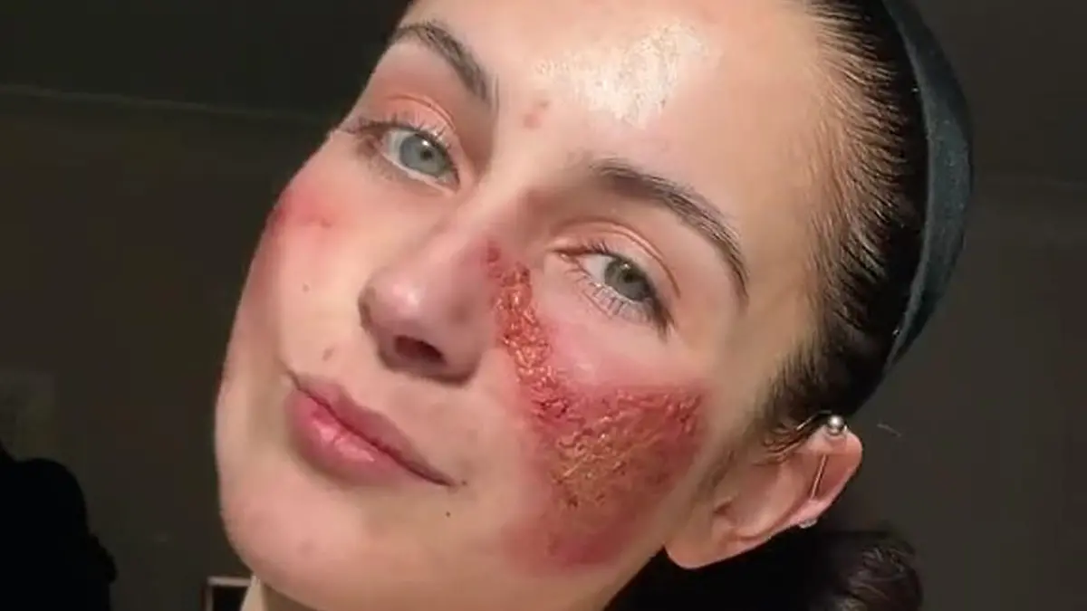 PIC FROM KENNEDY NEWS AND MEDIA (PICTURED: BETH TSANGARIDES, 20, AFTER A SKIN FLARE-UP) This young woman is so 'allergic to HERSELF' that even laughter can leave her looking like 'an acid attack victim' - but has finally worn makeup for the first time in years. Beth Tsangarides says her skin and body react to 'everything' she does, flaring up when she laughs or cries 'too much' and even going into anaphylaxis from many foods, herbs and spices. Horrifying photos show the 20-year-old's scorched, weeping and scabby skin that baffled docs claim is a 'medical mystery'. DISCLAIMER: While Kennedy News and Media uses its best endeavours to establish the copyright and authenticity of all pictures supplied, it accepts no liability for any damage, loss or legal action caused by the use of images supplied and the publication of images is solely at your discretion. SEE KENNEDY NEWS COPY - 0161 697 4266