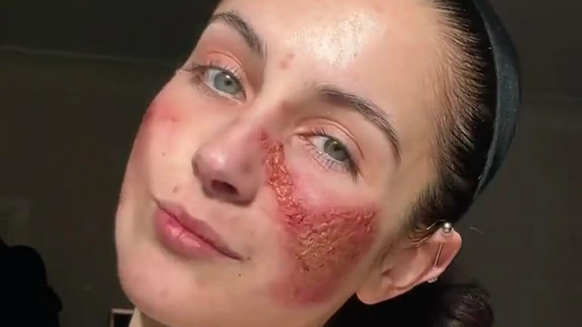 PIC FROM KENNEDY NEWS AND MEDIA (PICTURED: BETH TSANGARIDES, 20, AFTER A SKIN FLARE-UP) This young woman is so 'allergic to HERSELF' that even laughter can leave her looking like 'an acid attack victim' - but has finally worn makeup for the first time in years. Beth Tsangarides says her skin and body react to 'everything' she does, flaring up when she laughs or cries 'too much' and even going into anaphylaxis from many foods, herbs and spices. Horrifying photos show the 20-year-old's scorched, weeping and scabby skin that baffled docs claim is a 'medical mystery'. DISCLAIMER: While Kennedy News and Media uses its best endeavours to establish the copyright and authenticity of all pictures supplied, it accepts no liability for any damage, loss or legal action caused by the use of images supplied and the publication of images is solely at your discretion. SEE KENNEDY NEWS COPY - 0161 697 4266