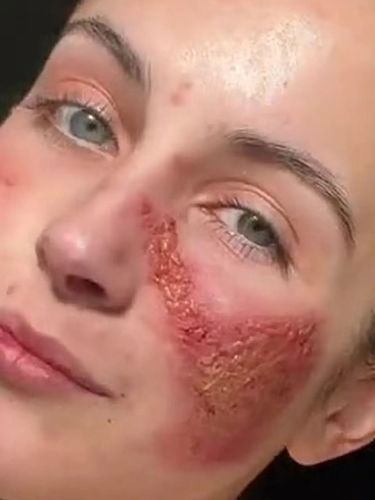 PIC FROM KENNEDY NEWS AND MEDIA (PICTURED: BETH TSANGARIDES, 20, AFTER A SKIN FLARE-UP) This young woman is so 'allergic to HERSELF' that even laughter can leave her looking like 'an acid attack victim' - but has finally worn makeup for the first time in years. Beth Tsangarides says her skin and body react to 'everything' she does, flaring up when she laughs or cries 'too much' and even going into anaphylaxis from many foods, herbs and spices. Horrifying photos show the 20-year-old's scorched, weeping and scabby skin that baffled docs claim is a 'medical mystery'. DISCLAIMER: While Kennedy News and Media uses its best endeavours to establish the copyright and authenticity of all pictures supplied, it accepts no liability for any damage, loss or legal action caused by the use of images supplied and the publication of images is solely at your discretion. SEE KENNEDY NEWS COPY - 0161 697 4266