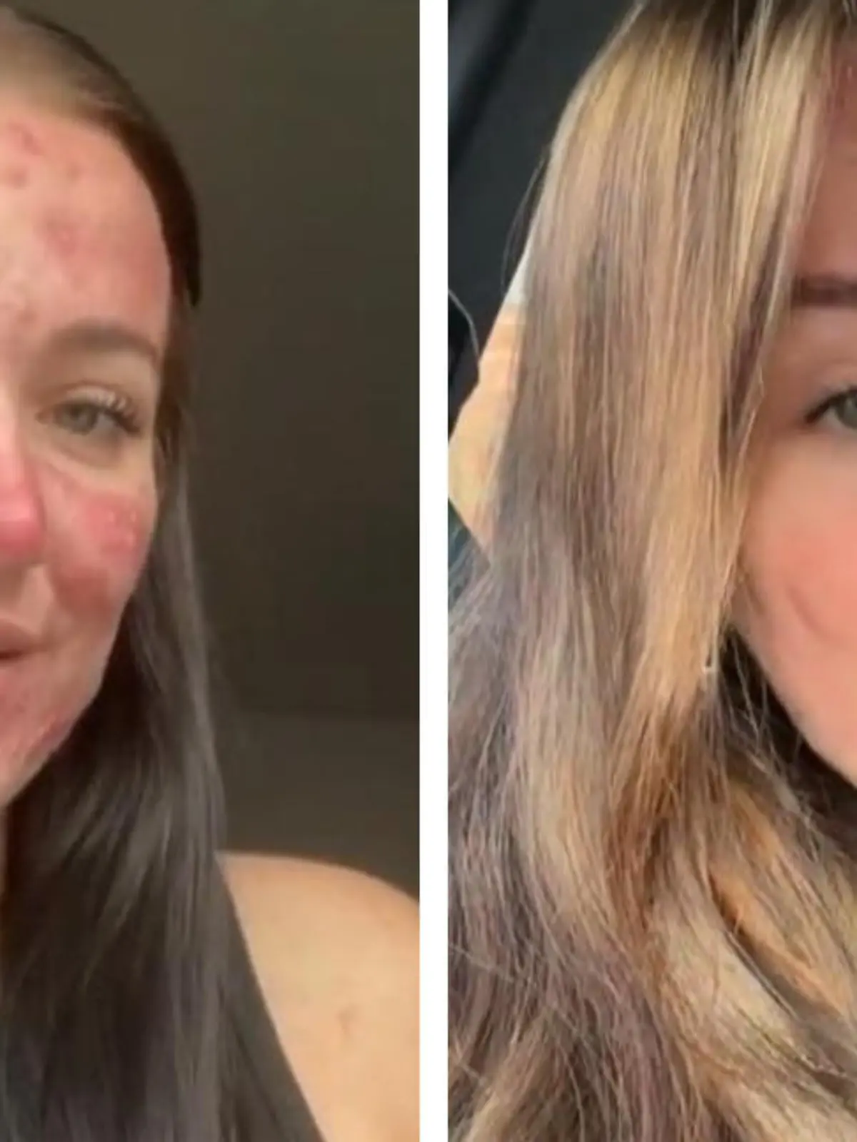 Courtney Jones aus England hat harte Zeiten hinter sich: Zu Teenagerzeiten wurde sie wegen ihrer Akne gemobbt, litt unter den mitleidigen Blicken der anderen. Doch dank der richtigen Hautpflege gehört all das heute der Vergangenheit an: Die 21-Jährige hat mittlerweile mehr als eine Millionen Follower auf Tiktok, arbeitet als Beauty-Influencerin und ist vielen ein Vorbild. Wie es dazu kam, erfahrt ihr im Video.