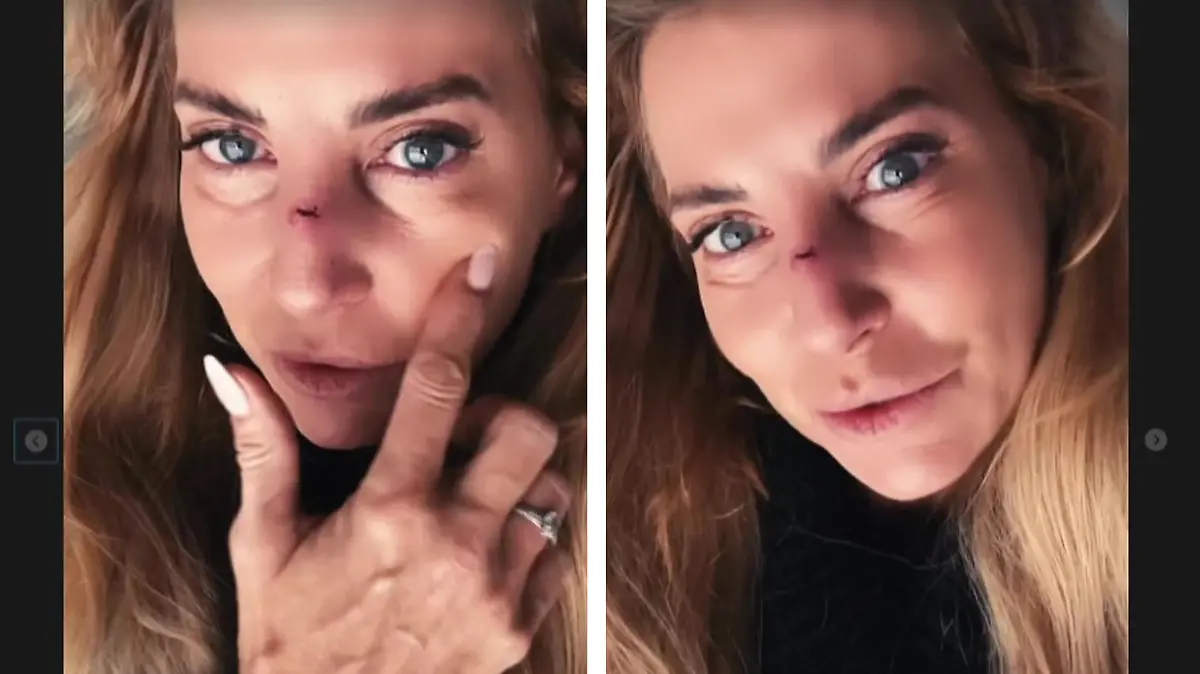 Giulia Siegel zeigt bei Instagram das Ergebnis von ihrer schmerzhaften Begegnung mit einer Glastüre.