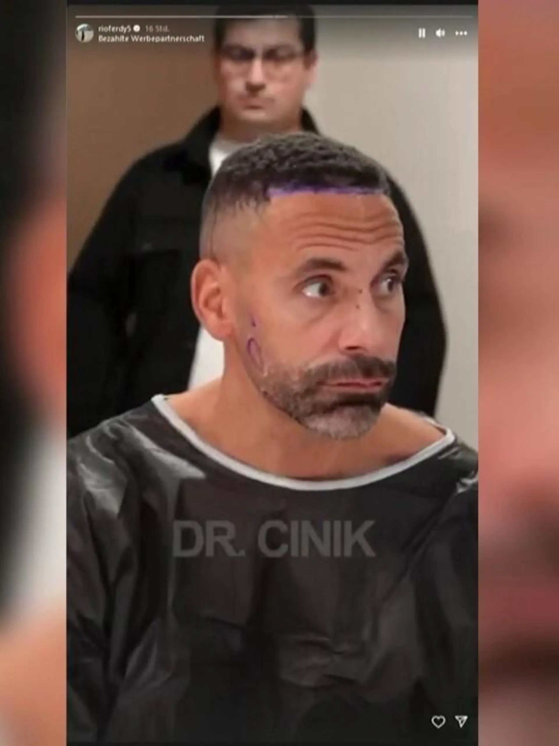 Rio Ferdinand steht zu seiner Haar- und Barttransplantation.