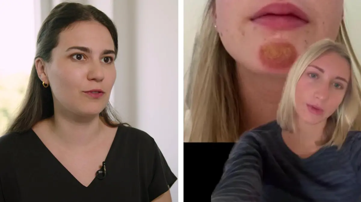 Dr. Alice Martin (links) erklärt, was hinter dem fiesen Ekzem am Kinn einer TikTok-Nutzerin steckt.