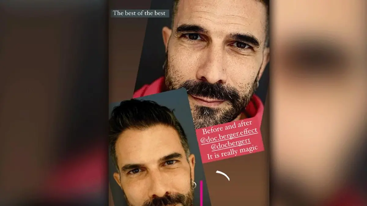 Marc Terenzi hat eine Beauty-Doc an sein Gesicht gelassen.