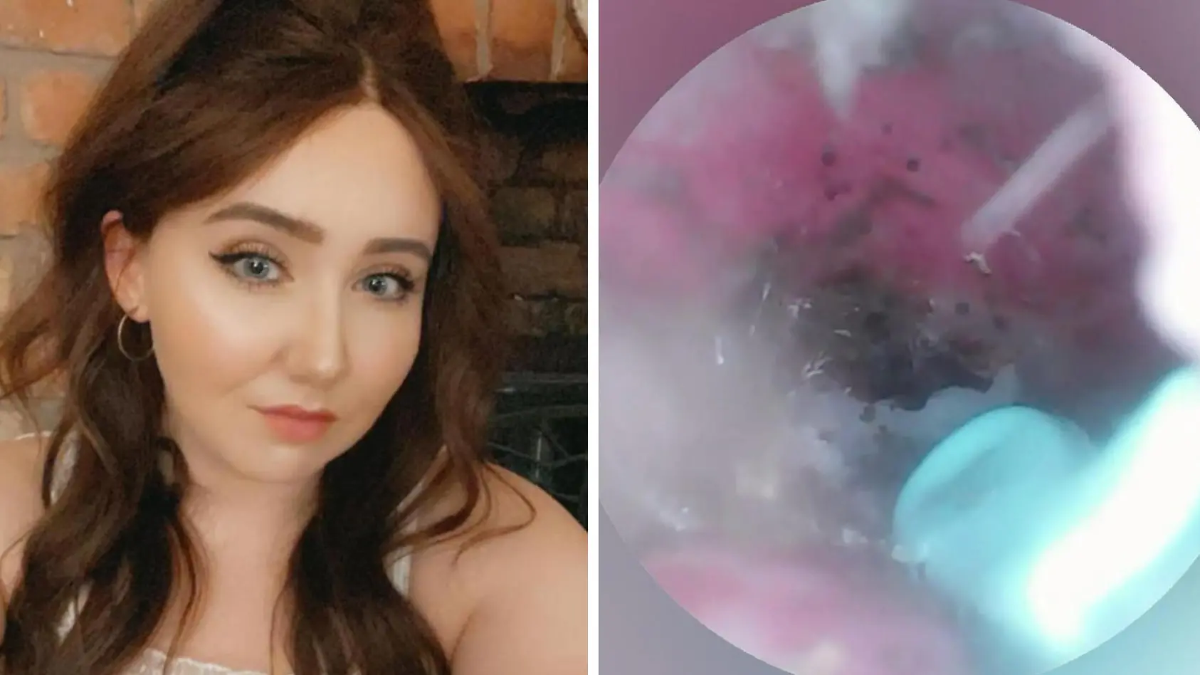 Frau hat Riesen-Spinnennest im Ohr