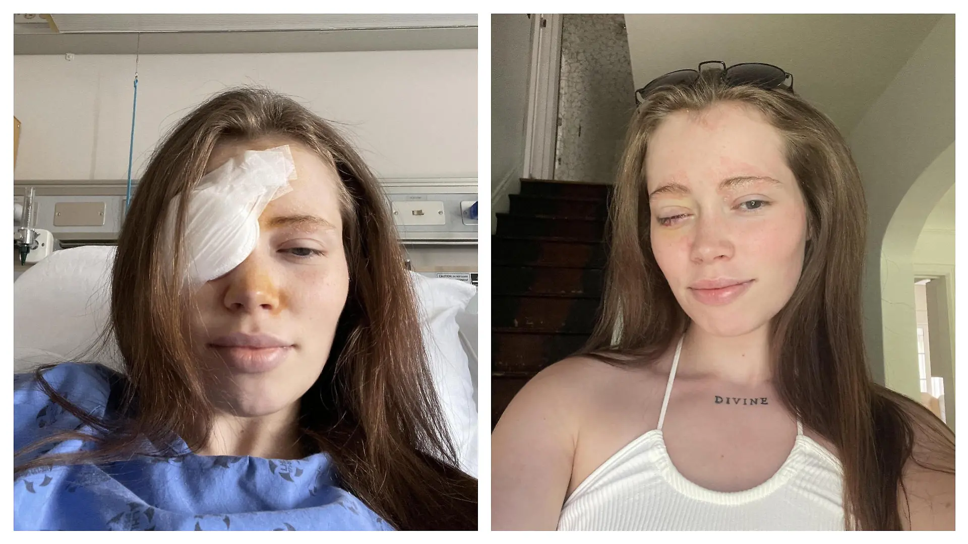 Taiva Finlayson nach ihrer Augenoperation.